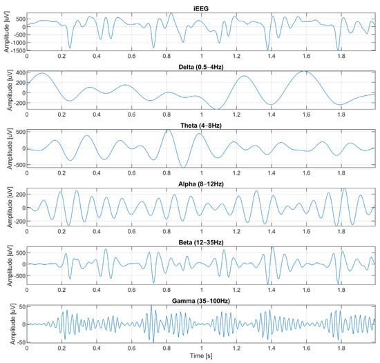 A clinical evaluation of a novel algorithm in the reliable detection of  epileptic seizures - ScienceDirect