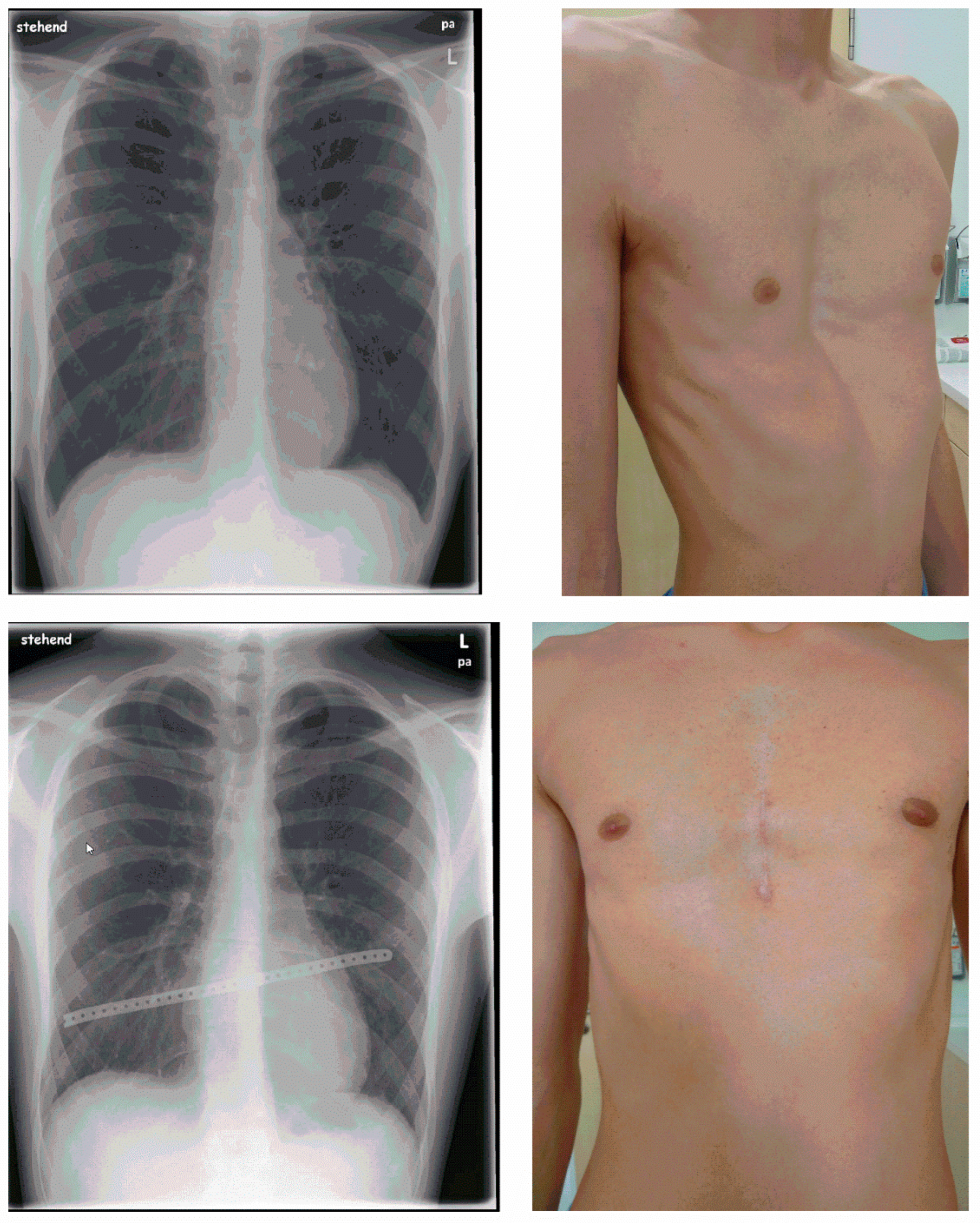 Applied Sciences | Free Full-Text | Minimalized Erlangen Correction Method  by H&uuml;mmer (MEK) Compared with Conventional and Minimally Invasive  Correction Methods for Pectus Excavatum Single Center Experience