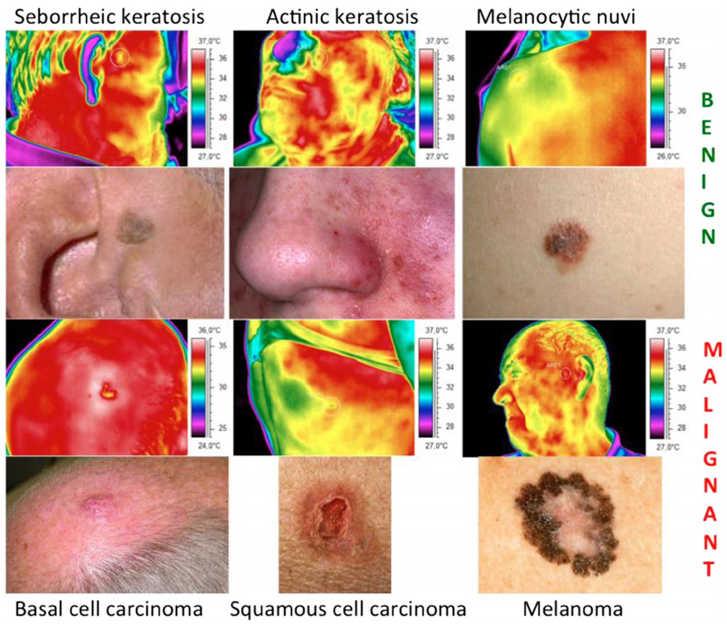 An inverse heat transfer approach for patient-specific breast cancer  detection and tumor localization using surface thermal images in the prone  position - ScienceDirect