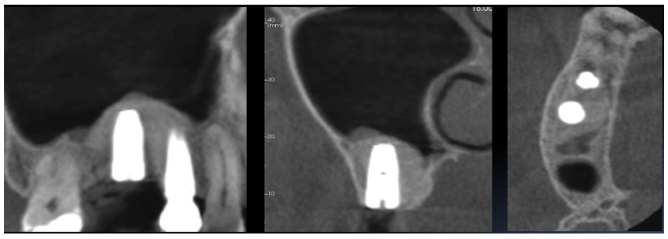 Applied Sciences | Free Full-Text | Crestal Sinus Lift with the ...