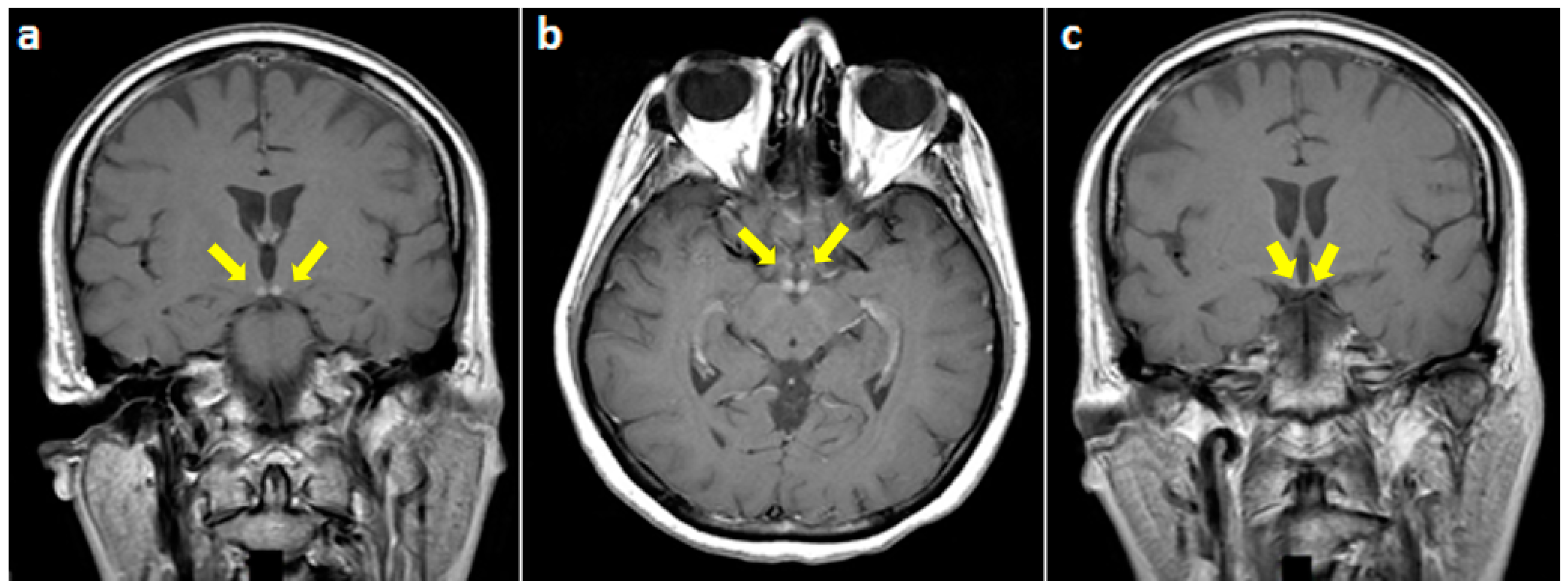 Behavioral Sciences | Free Full-Text | Isolated Mammillary Bodies Damage—An  Atypical Presentation of Wernicke Syndrome