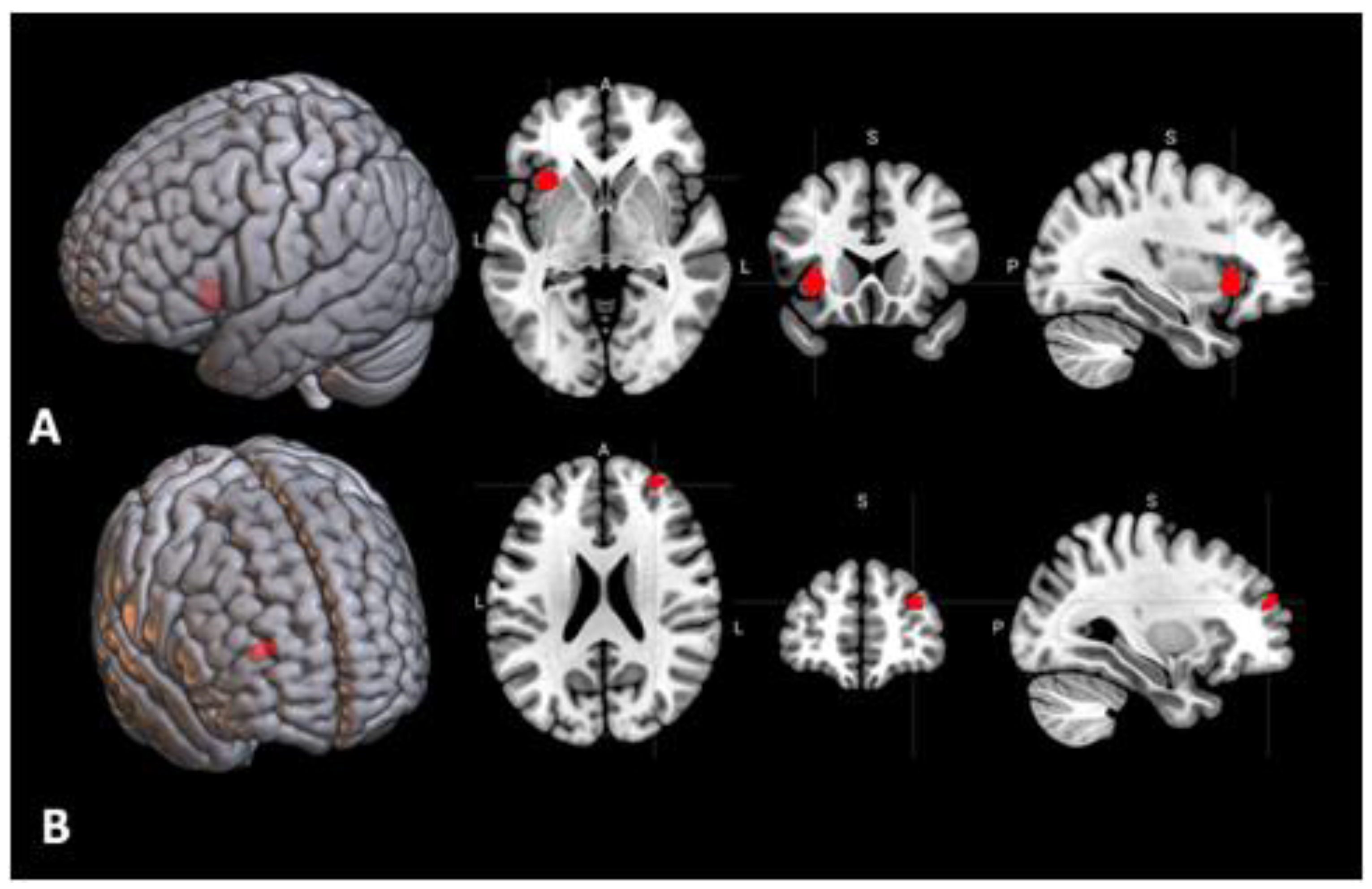 Behavioral Sciences Free Full Text Brain Activations And Functional Connectivity Patterns Associated With Insight Based And Analytical Anagram Solving Html