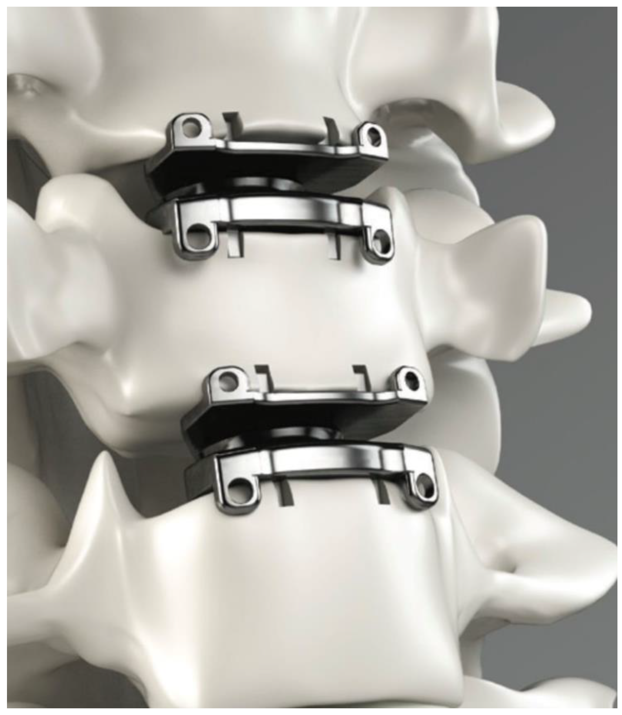 Bioengineering Free Full Text Cervical And Lumbar Disc Arthroplasty A Review Of Current 