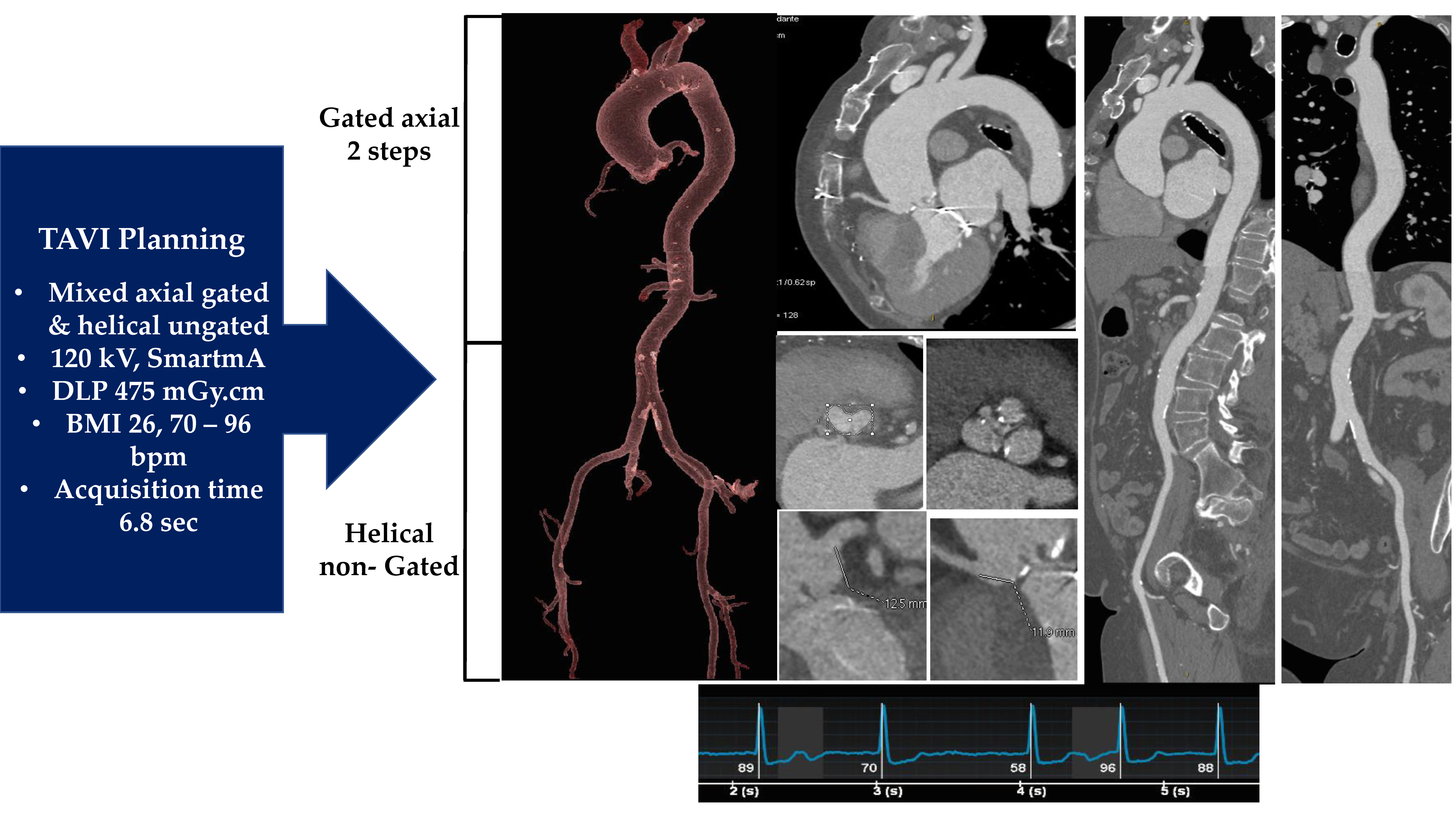 Aaron Boone - Aortic Valve Repair & Aortic Root Replacement Surgery