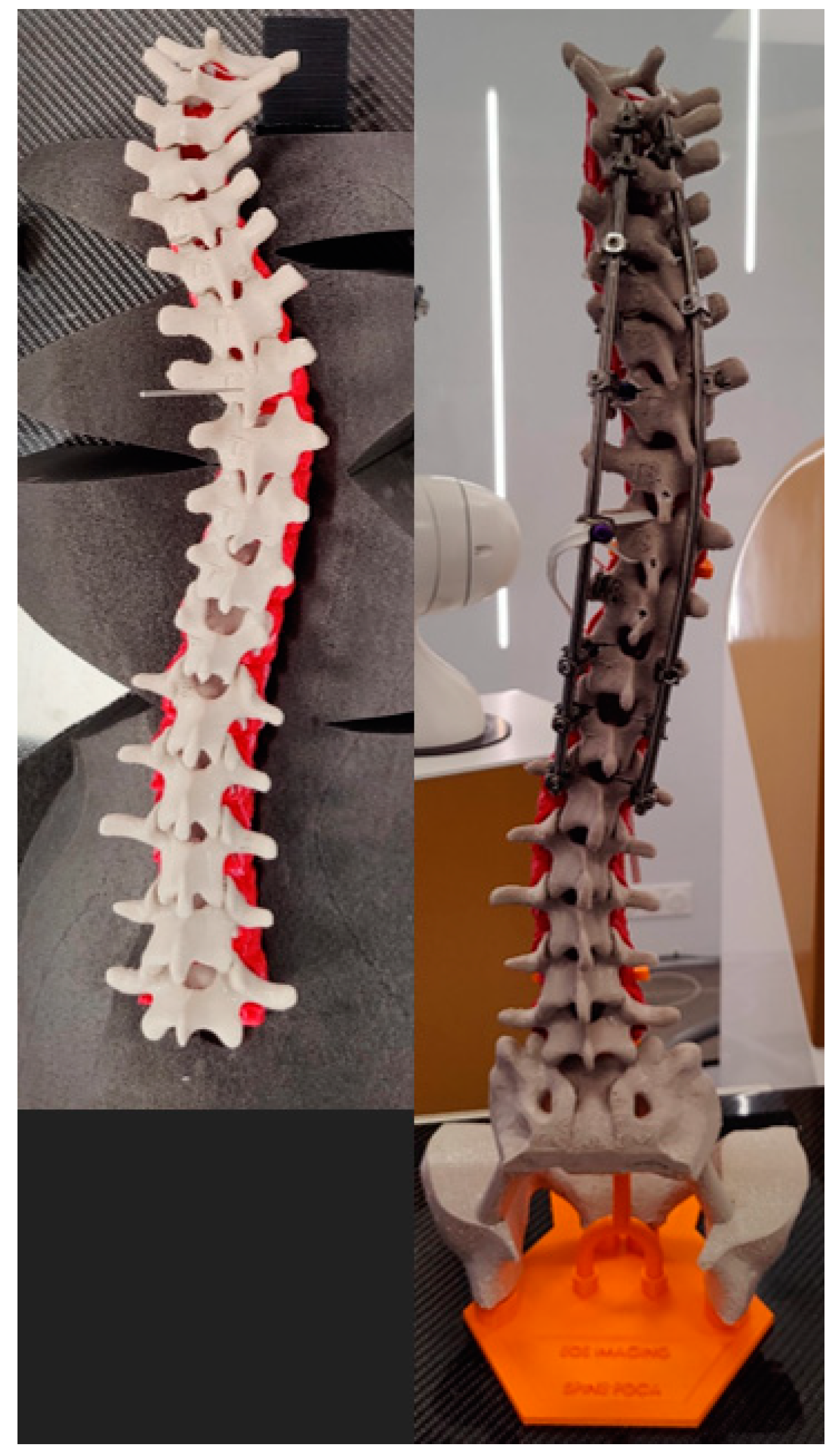 Bioengineering | Free Full-Text | Virtual Scoliosis Surgery Using a 3D-Printed  Model Based on Biplanar Radiographs