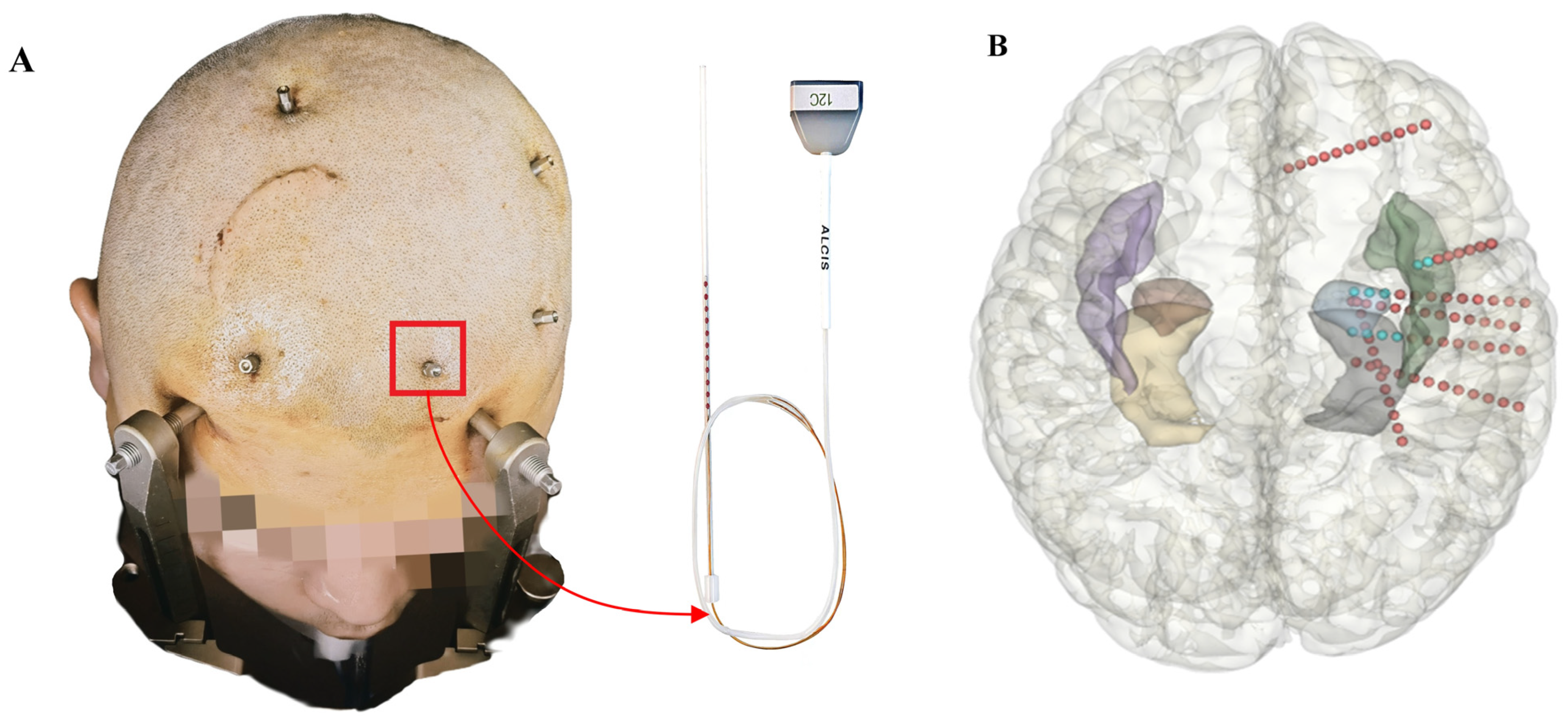 Deep anomaly detection of seizures with paired stereoelectroencephalography  and video recordings