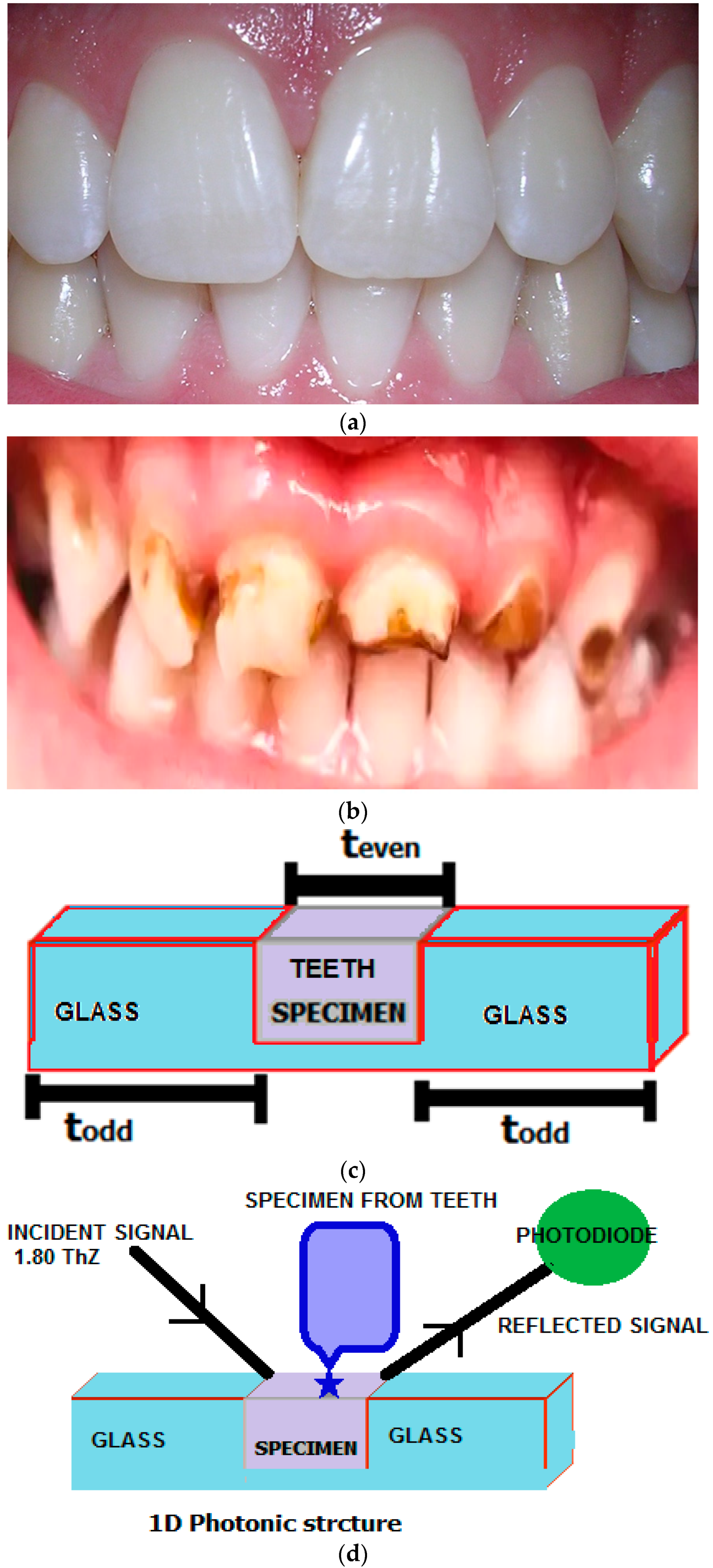 Bioengineering | Free Full-Text | Investigation on Enamel and Dentine of  Tooth through 1D Photonic Structure to Identify the Caries in Human Teeth