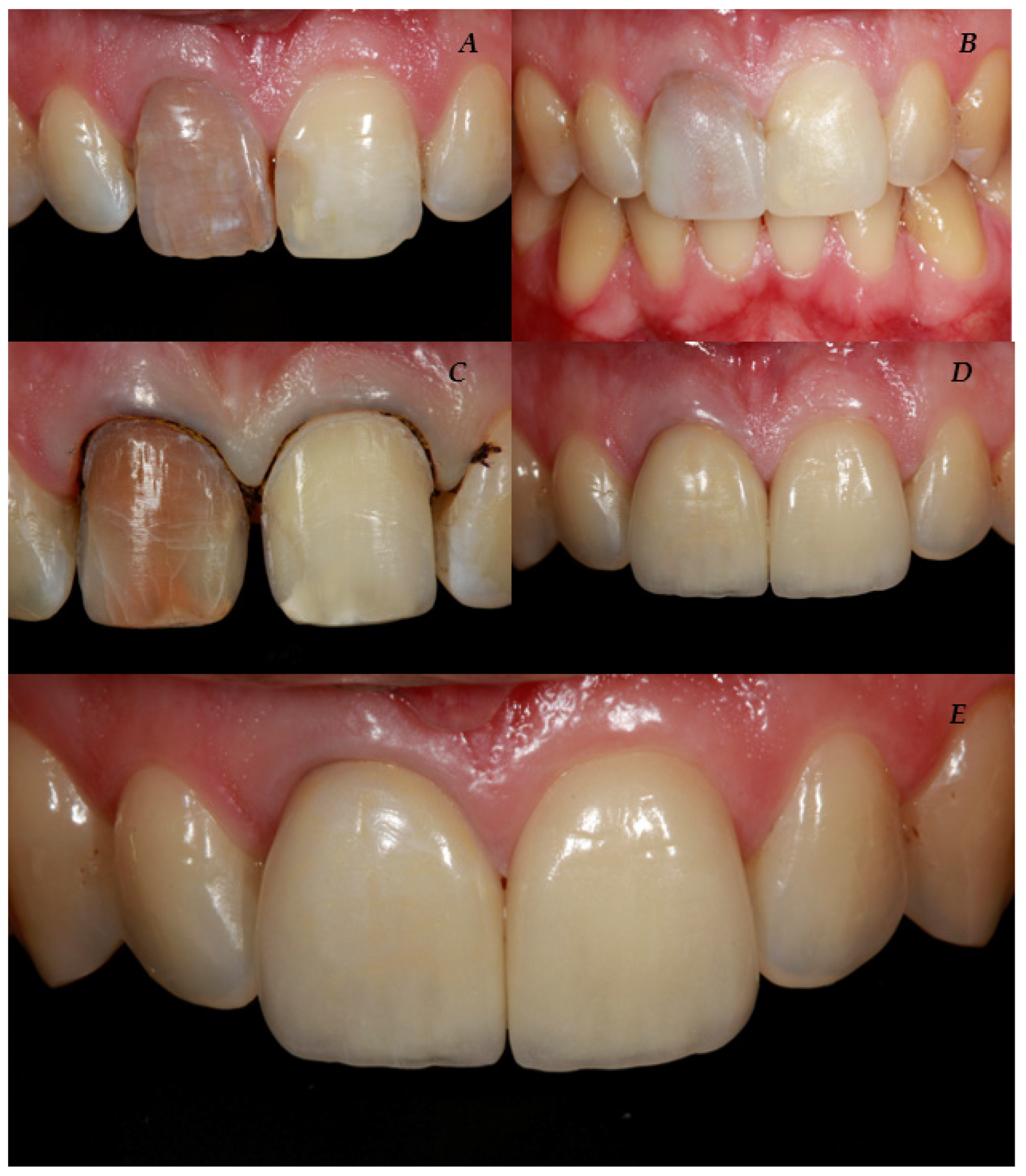 Bleaching of Non-vital Discolored Teeth: Keys of Success - Dental News