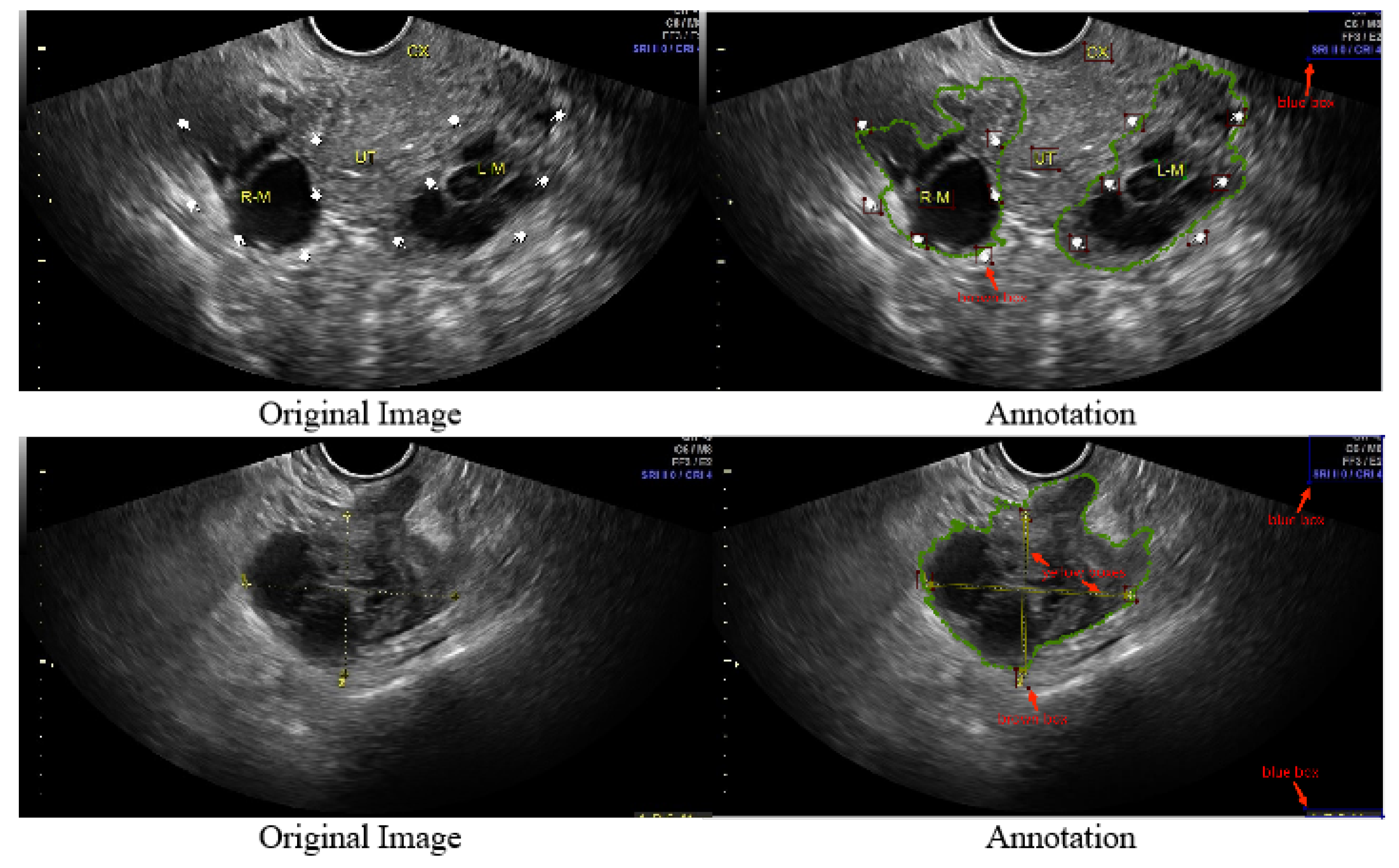 pathology-of-ovarian-tumors-quick-review-epomedicine-my-xxx-hot-girl