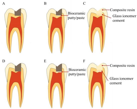 Bioengineering | Free Full-Text | Bioceramics in Endodontics: Updates and  Future Perspectives