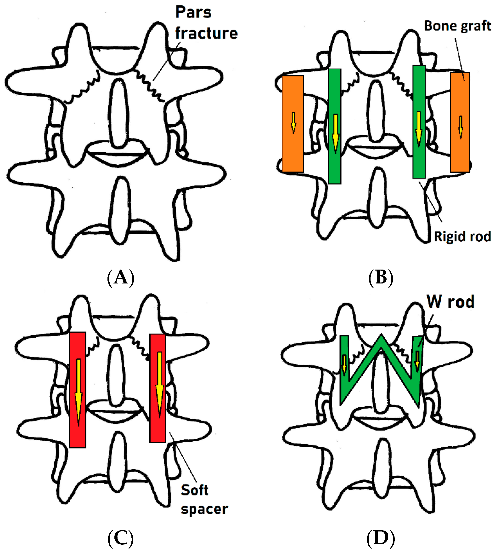 Bioengineering Free Full Text Biomechanical Effects Of A Novel Pedicle Screw W Type Rod