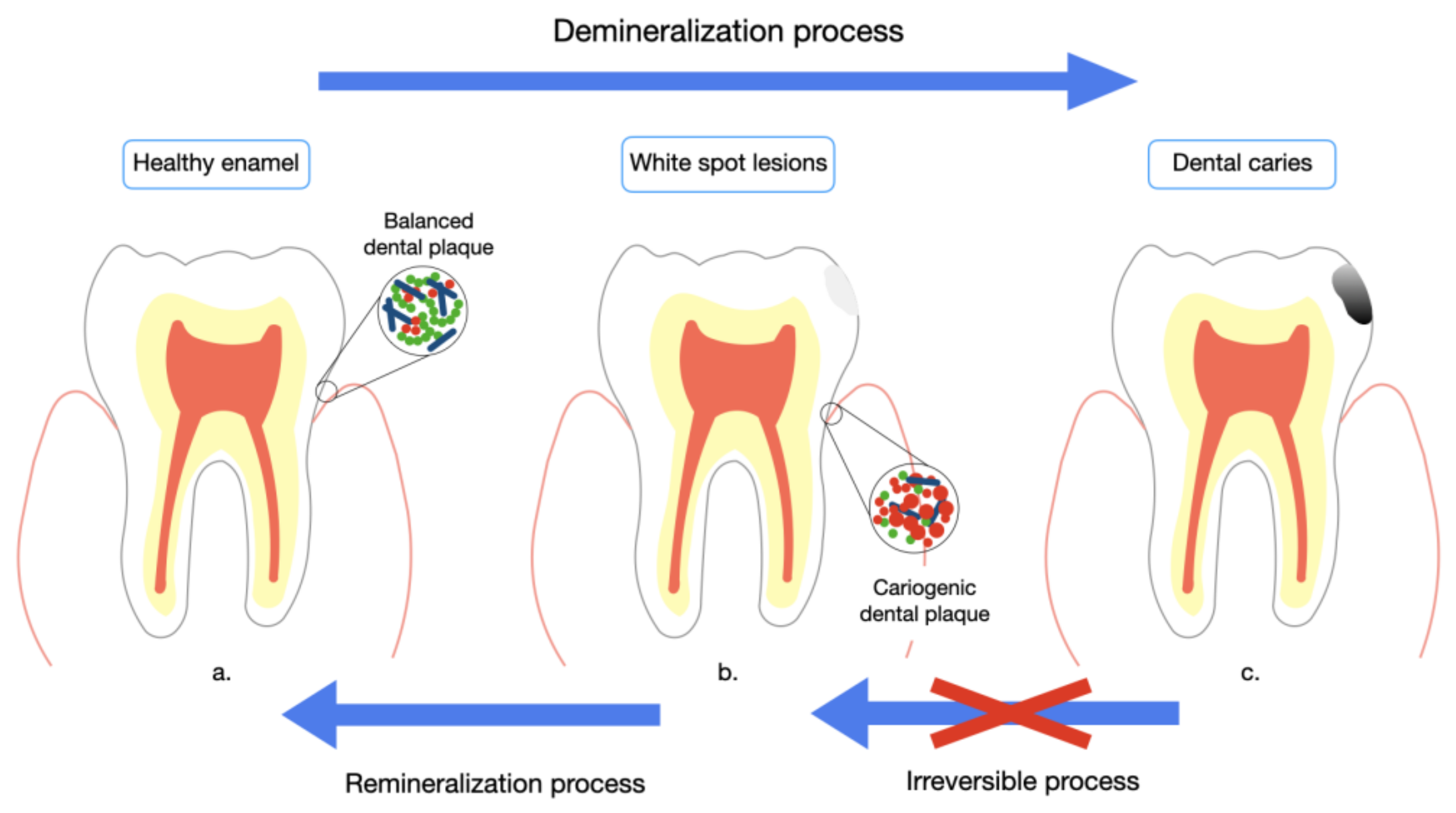 MI Paste, a Product to Remineralize the Tooth Enamel.