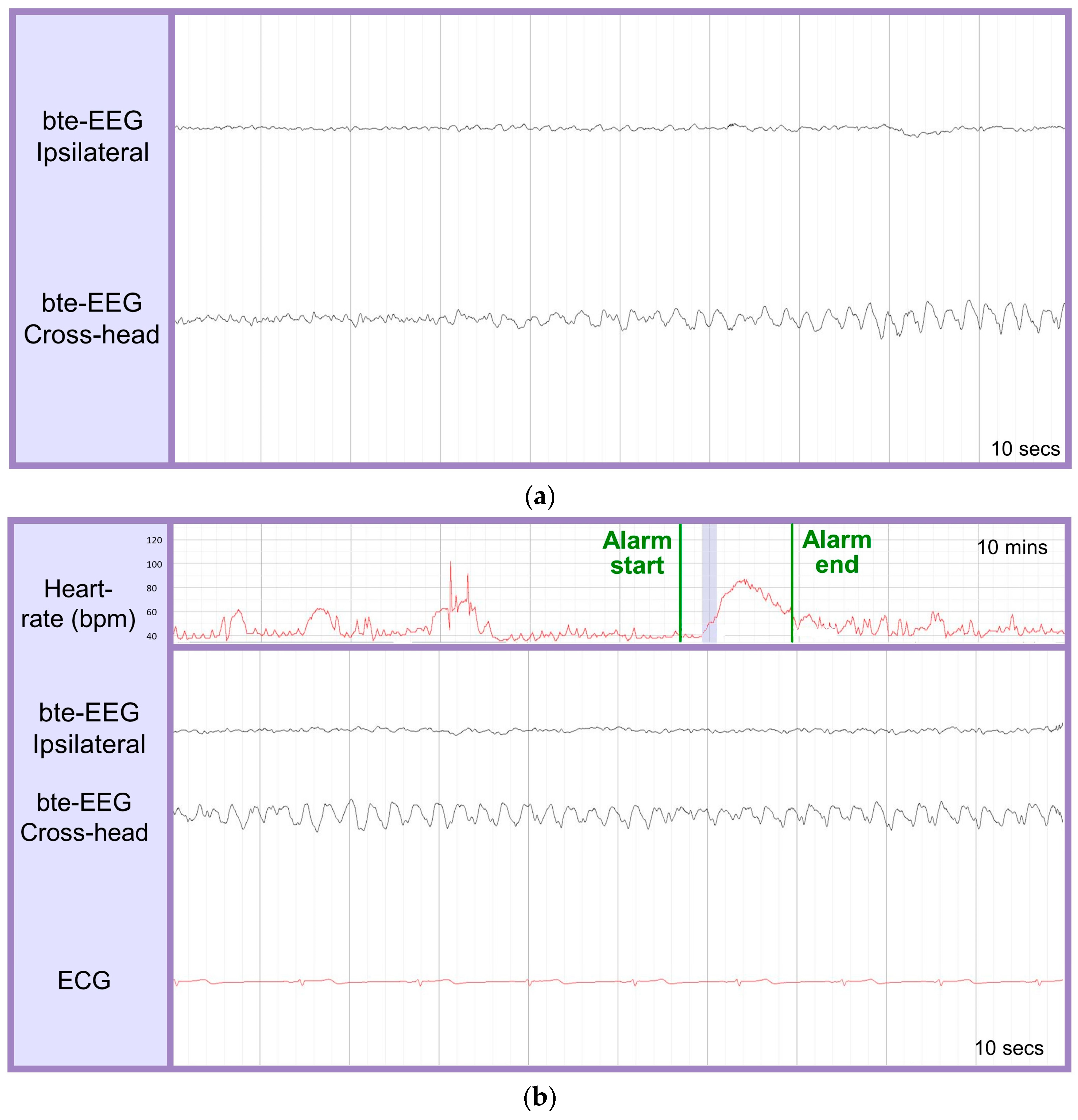 Abrazo Health using AI-powered EEG system for seizure detection