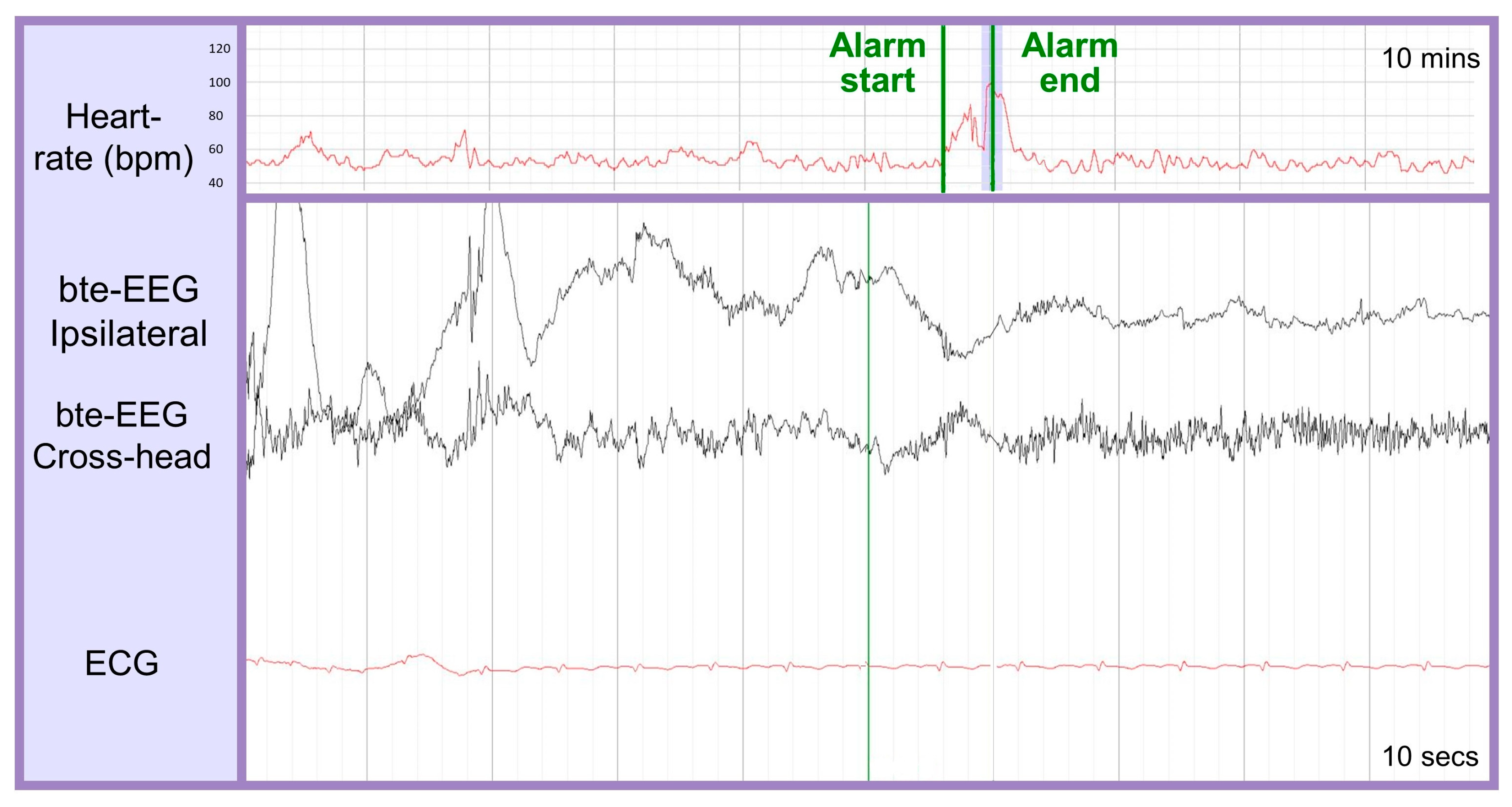 Abrazo Health using AI-powered EEG system for seizure detection