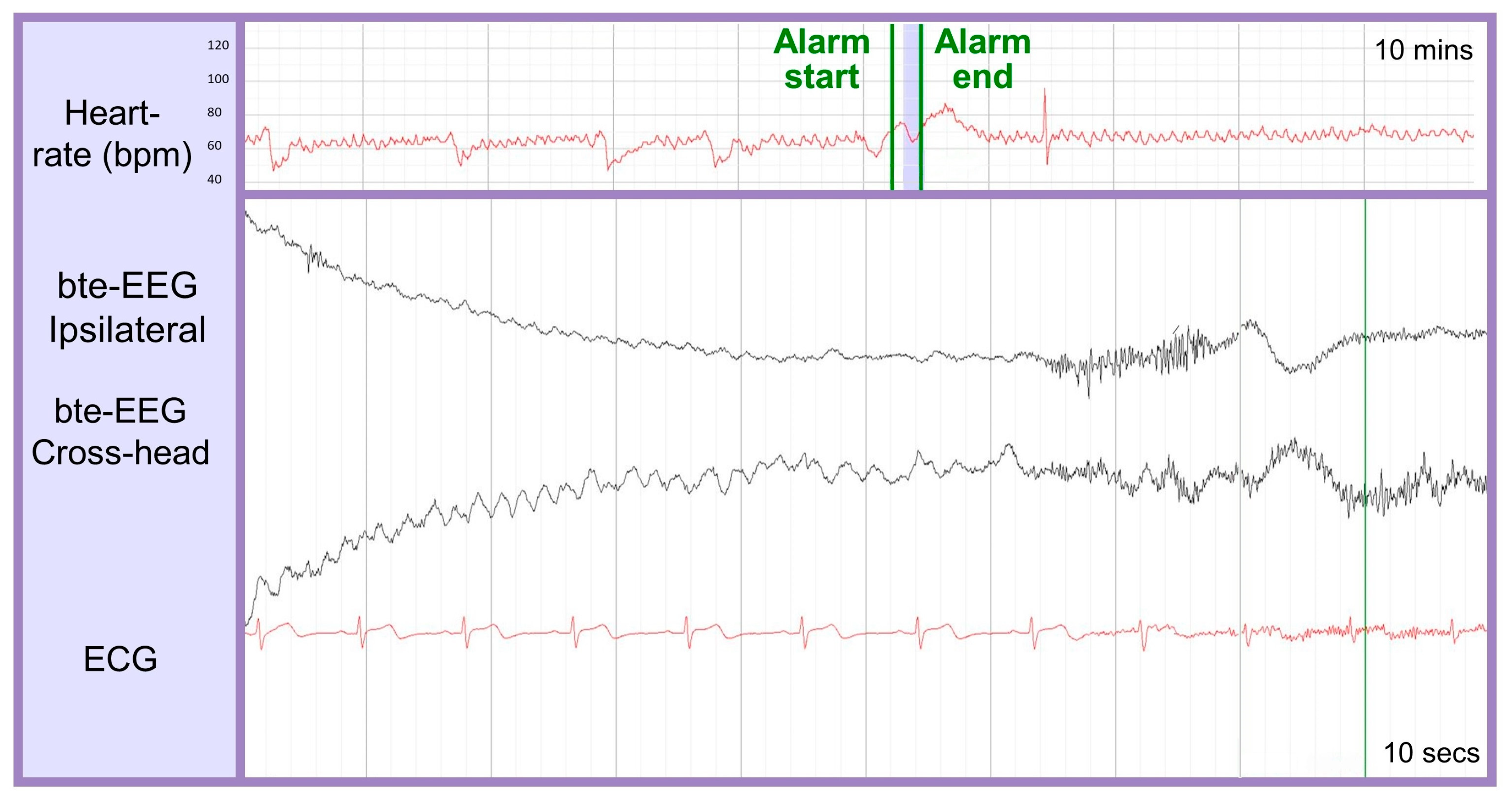 Abrazo Health using AI-powered EEG system for seizure detection