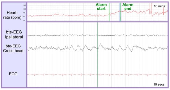 Abrazo Health using AI-powered EEG system for seizure detection