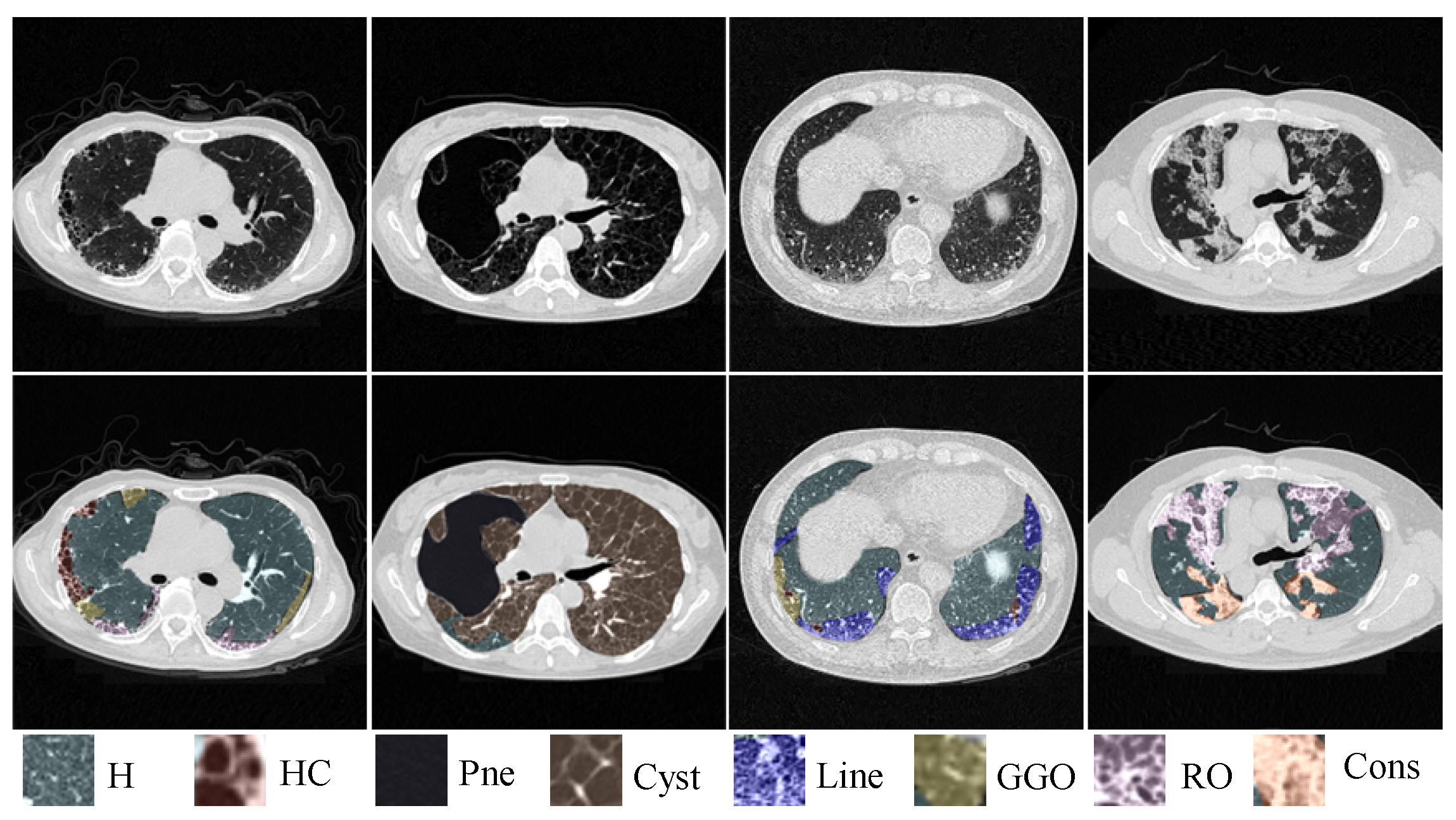 Bioengineering Free Full Text Semi Supervised Segmentation Of Interstitial Lung Disease 0919