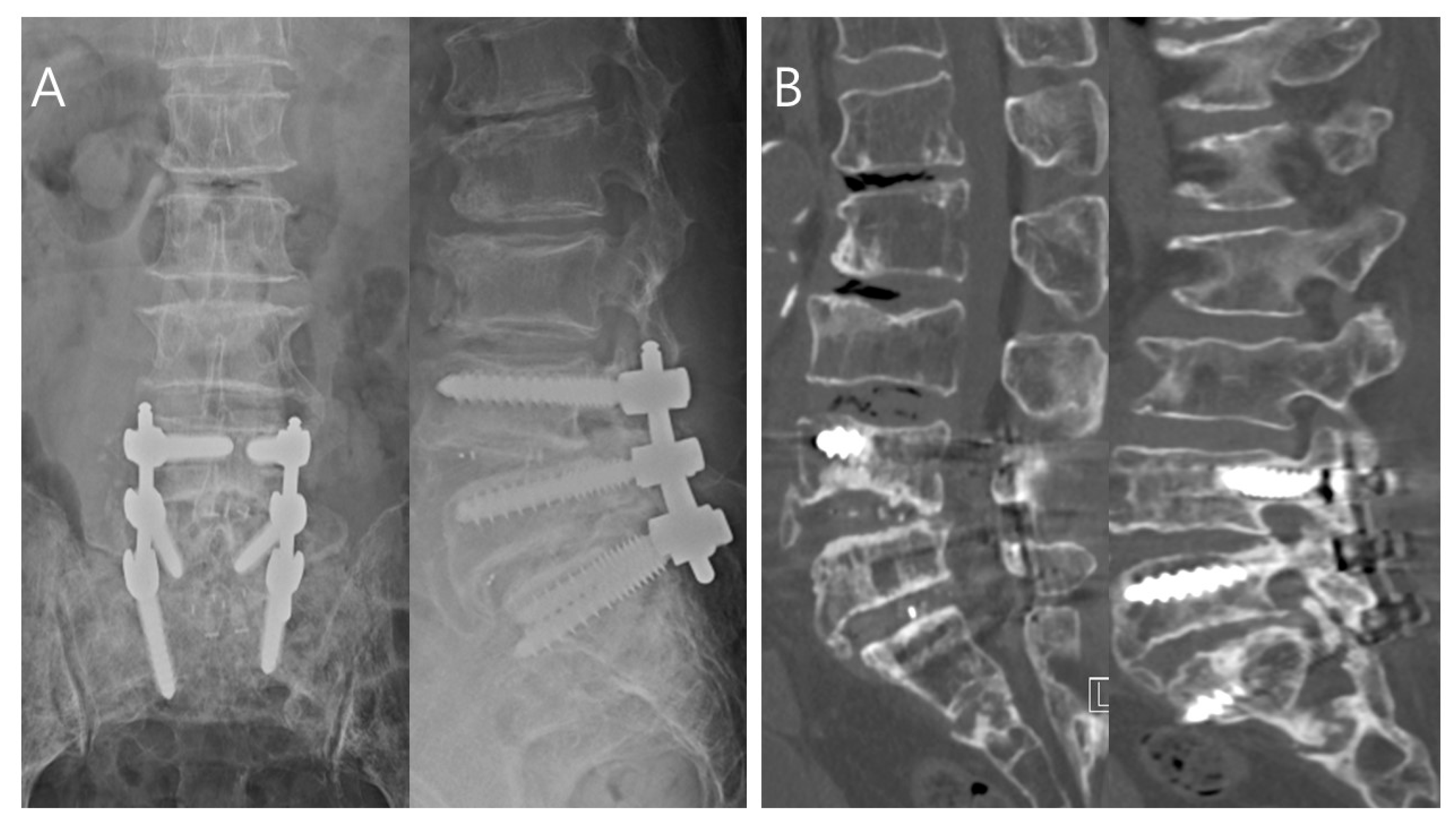 Association of tranexamic acid with decreased blood loss in patients  undergoing laminectomy and fusion with posterior instrumentation: a  systematic review and meta-analysis in: Journal of Neurosurgery: Spine  Volume 36 Issue 4 (2021) Journals