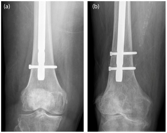 Nail Dynamization for Delayed Union and Nonunion in Femur and Tibia  Fractures