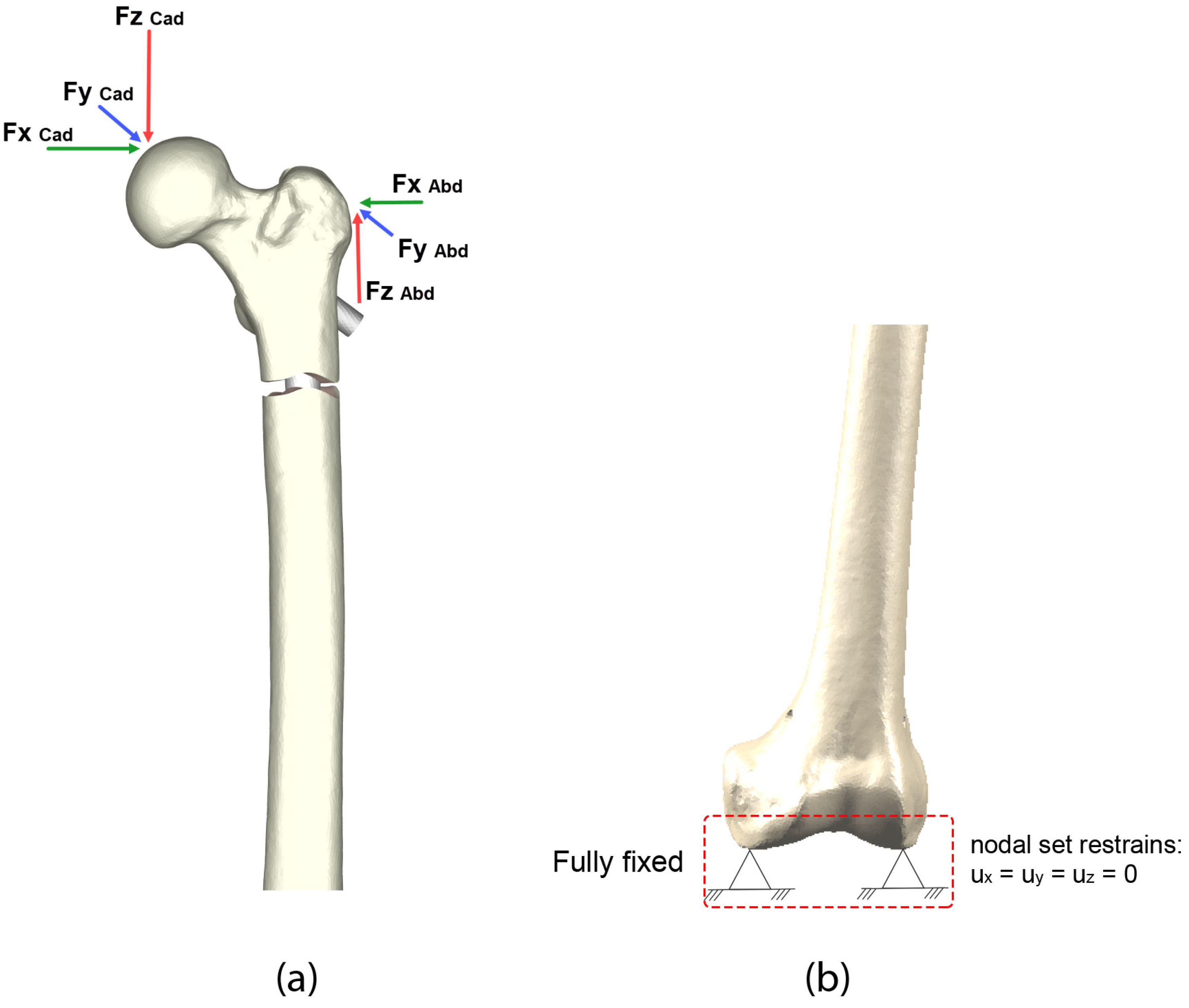 JFMK | Free Full-Text | Antibiotic-Coated Nail in Open Tibial Fracture: A  Retrospective Case Series