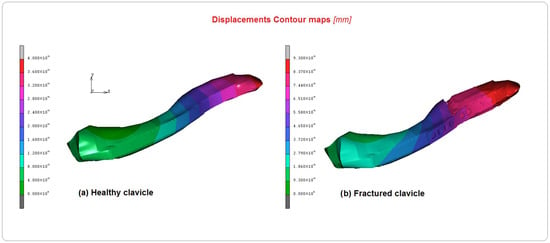 Biomechanical effects of different numbers and locations of screw