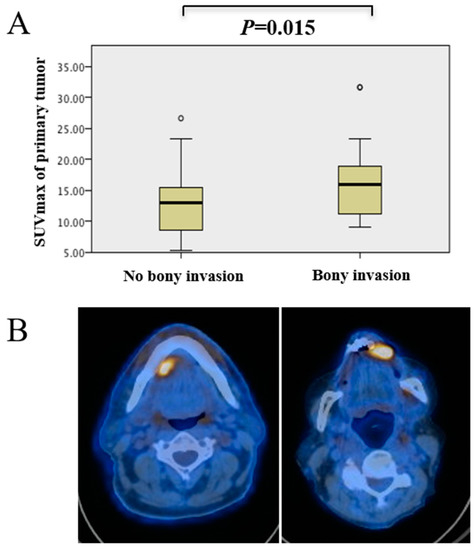 Biology | Free Full-Text | Value of SUVmax for the Prediction of Bone  Invasion in Oral Squamous Cell Carcinoma
