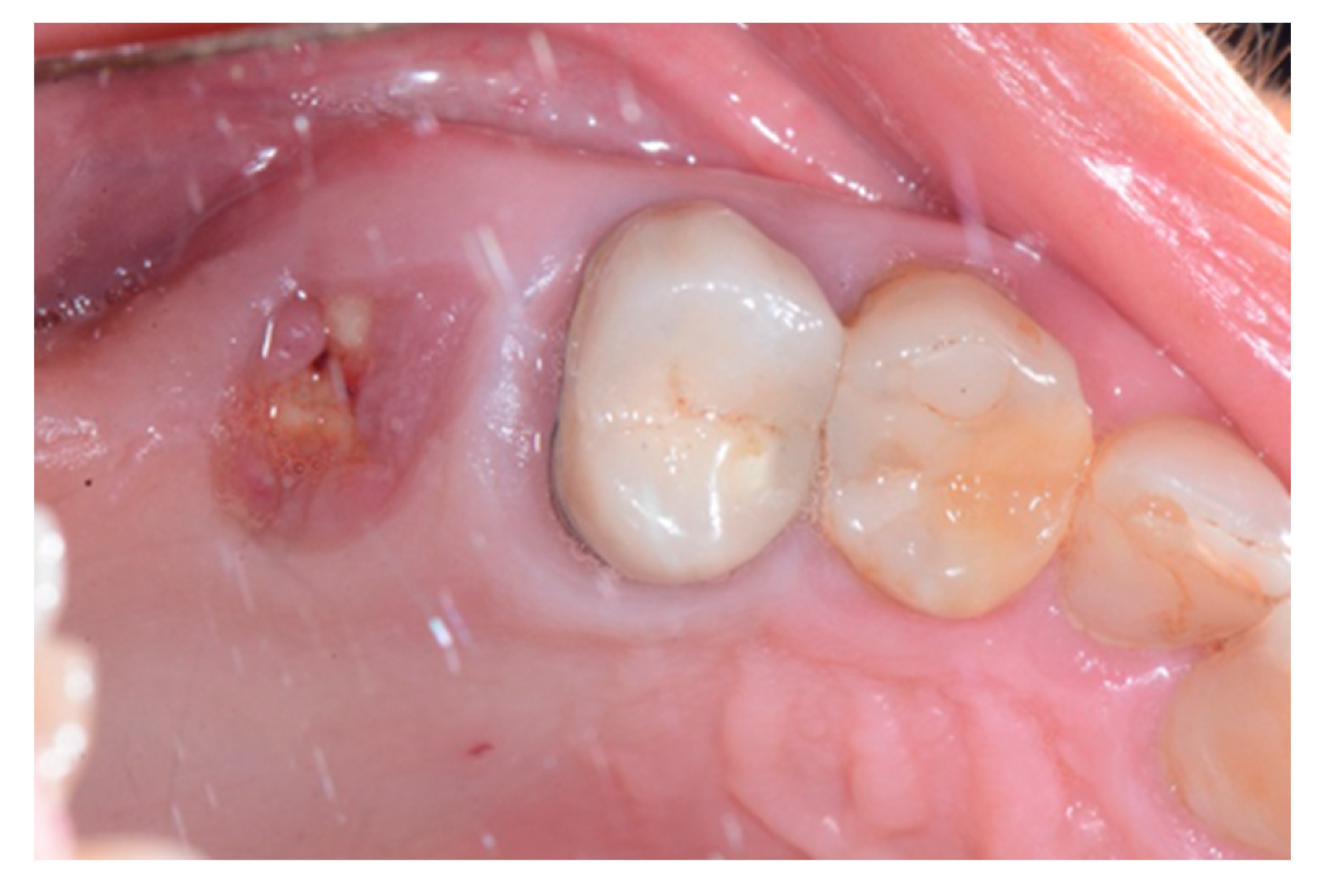 granulation tissue tooth extraction