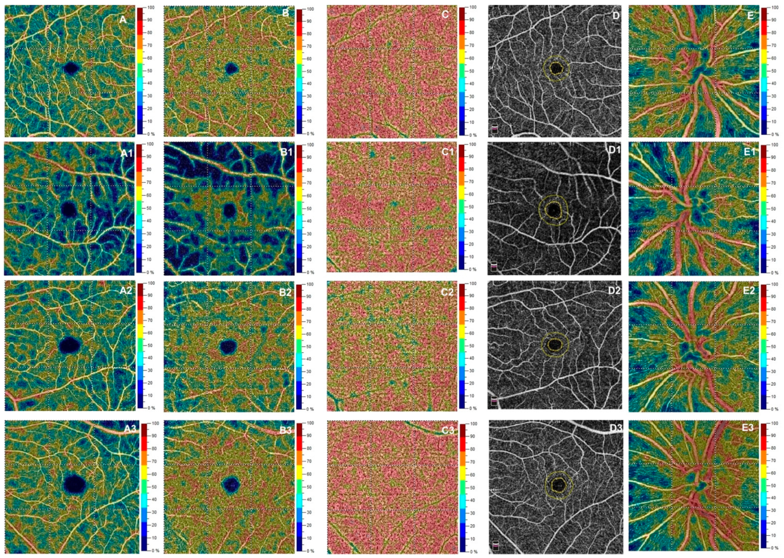 Biology | Free Full-Text | Retinal and Choriocapillaris Vascular Changes in  Patients Affected by Different Clinical Phenotypes of β-Thalassemia: An  Optical Coherence Tomography Angiography Study