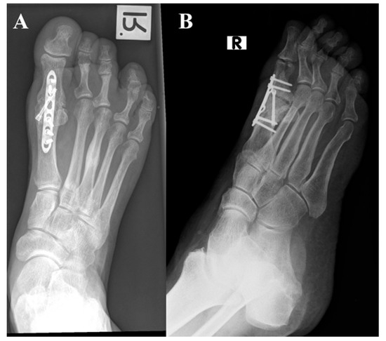 Ball and socket ankle joint  Radiology Reference Article