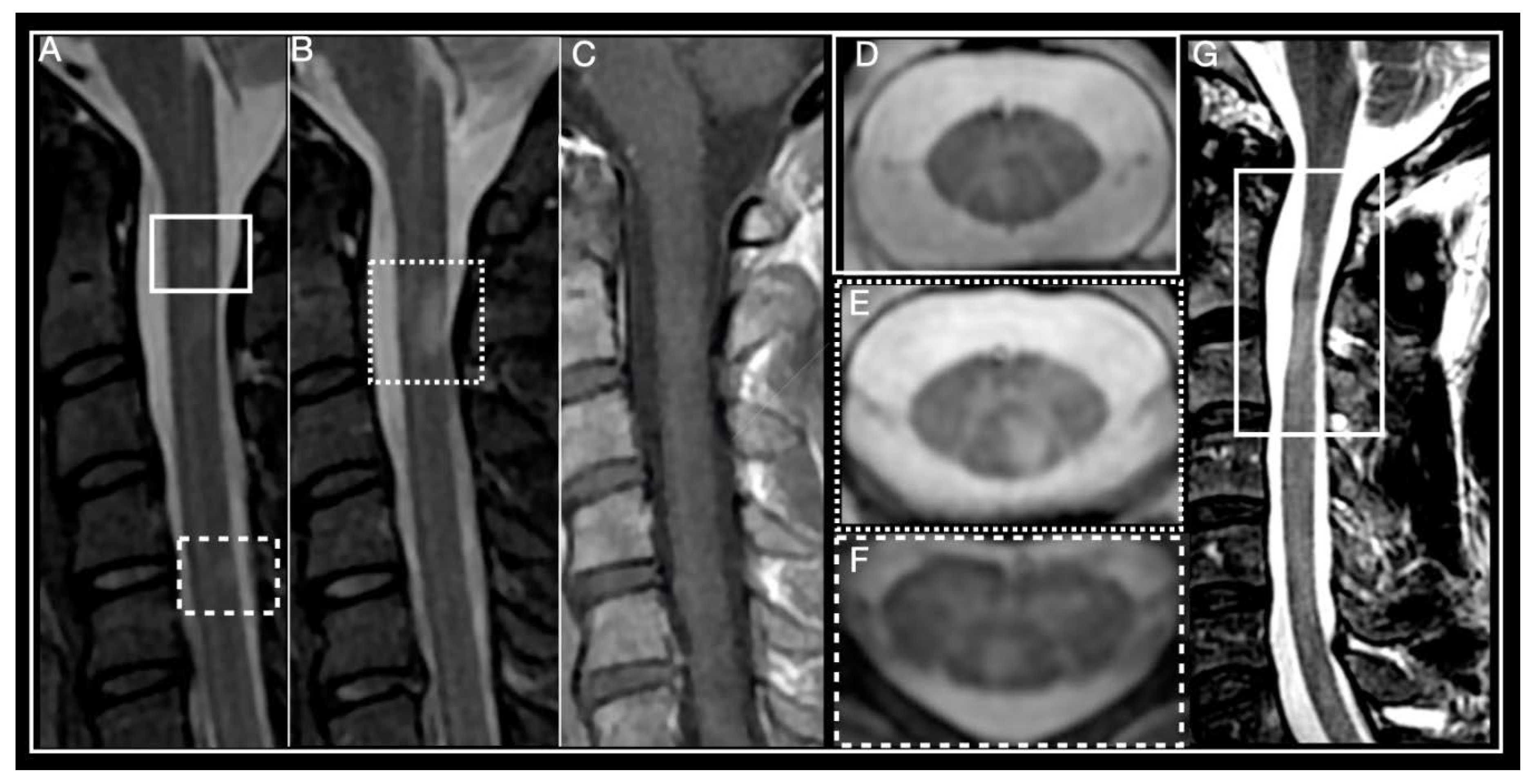 early ms mri spine