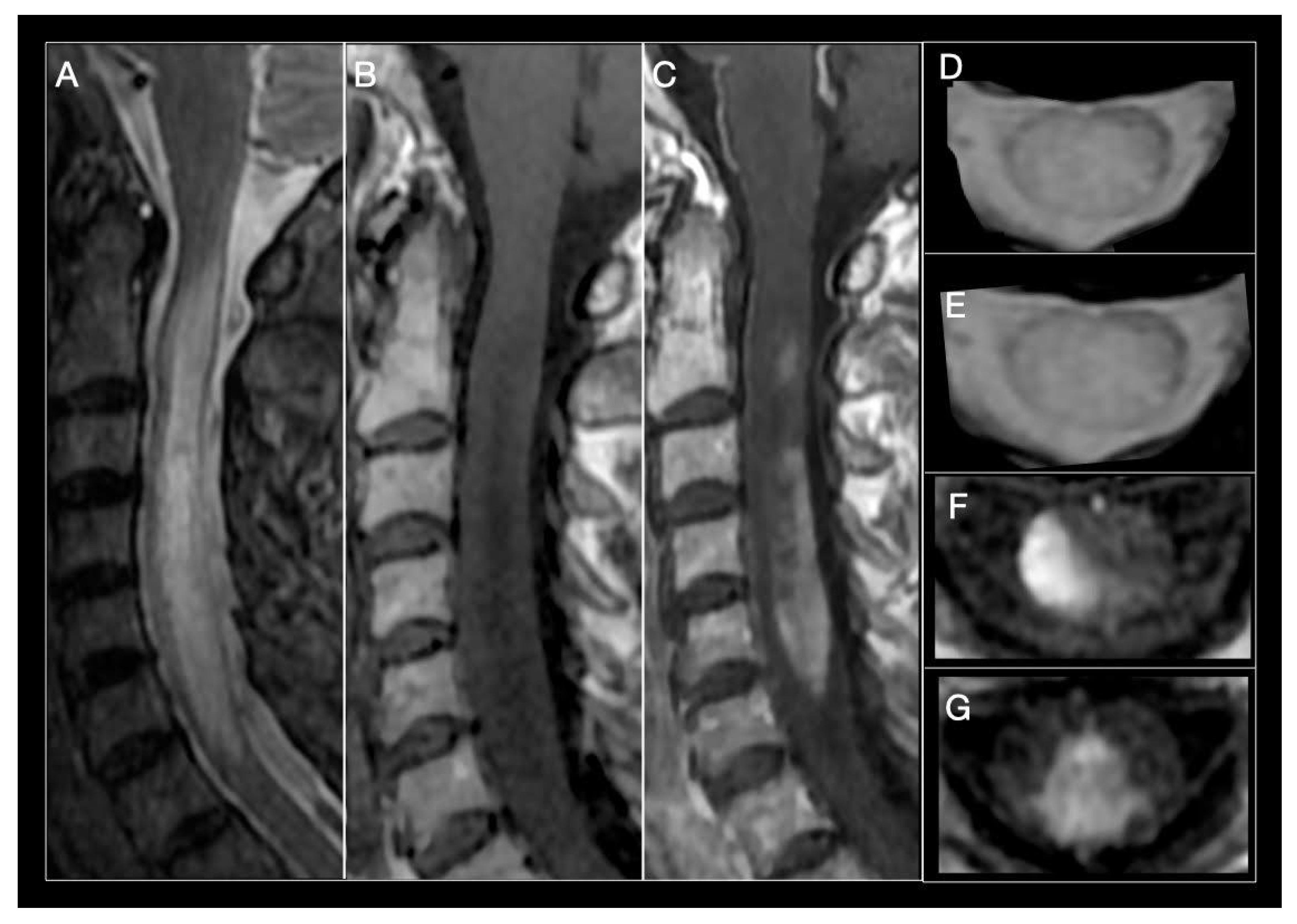 Biomedicines | Free Full-Text | Spinal Cord Involvement in MS and Other  Demyelinating Diseases