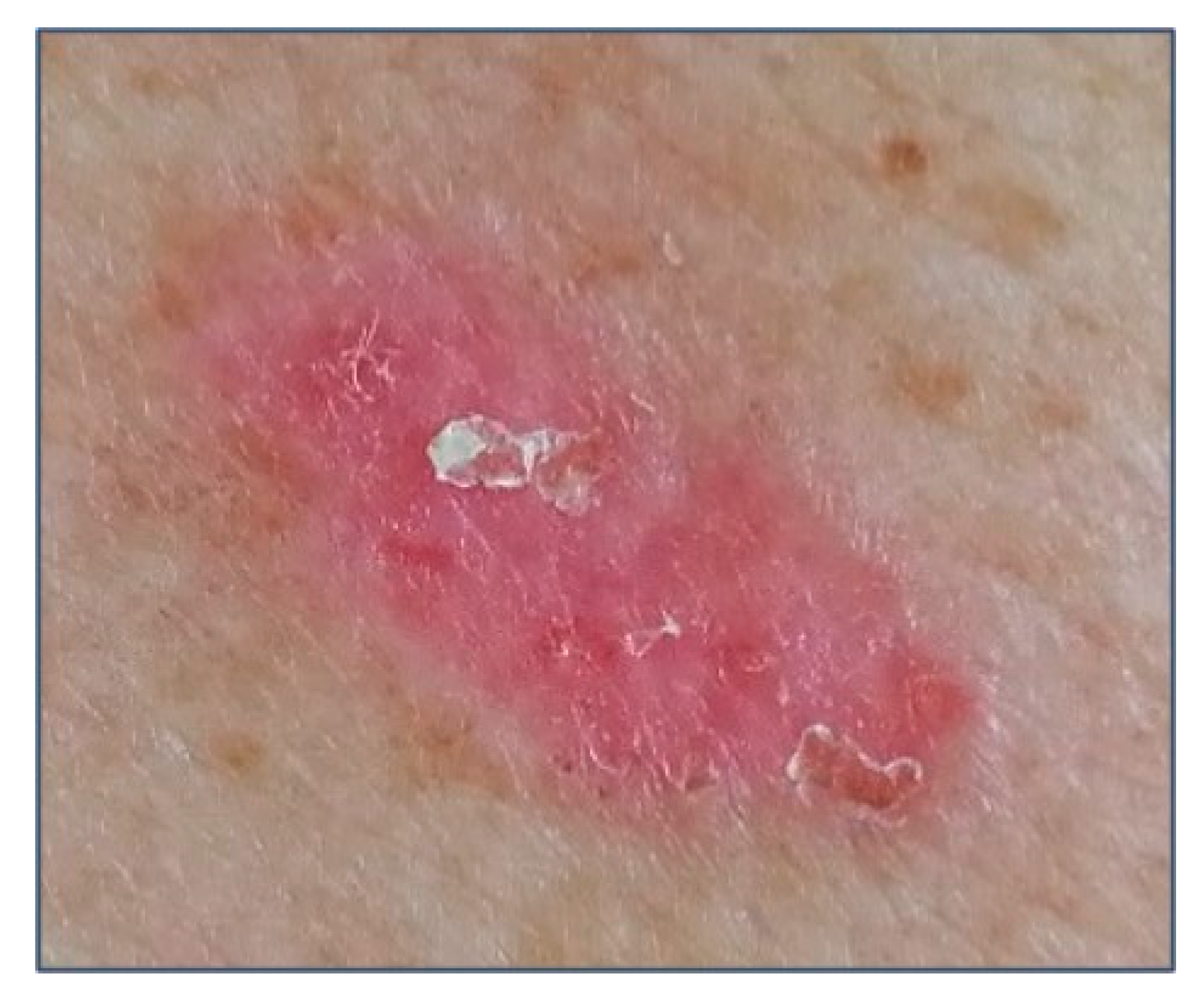 superficial basal cell carcinoma early stages