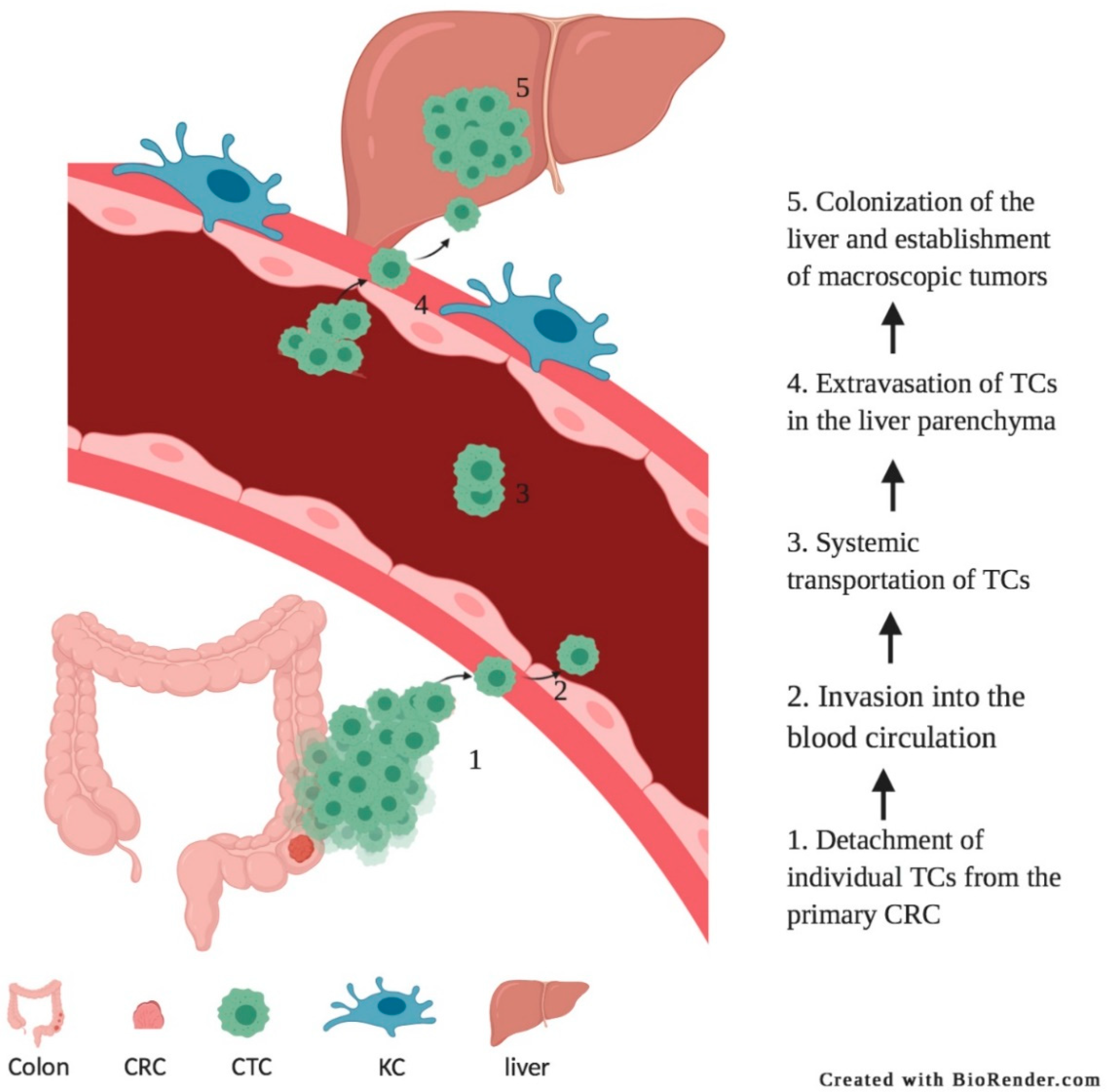 Biomedicines | Free Full-Text | Surgery for Colorectal Cancer: A Trigger  for Liver Metastases Development? New Insights into the Underlying  Mechanisms | HTML