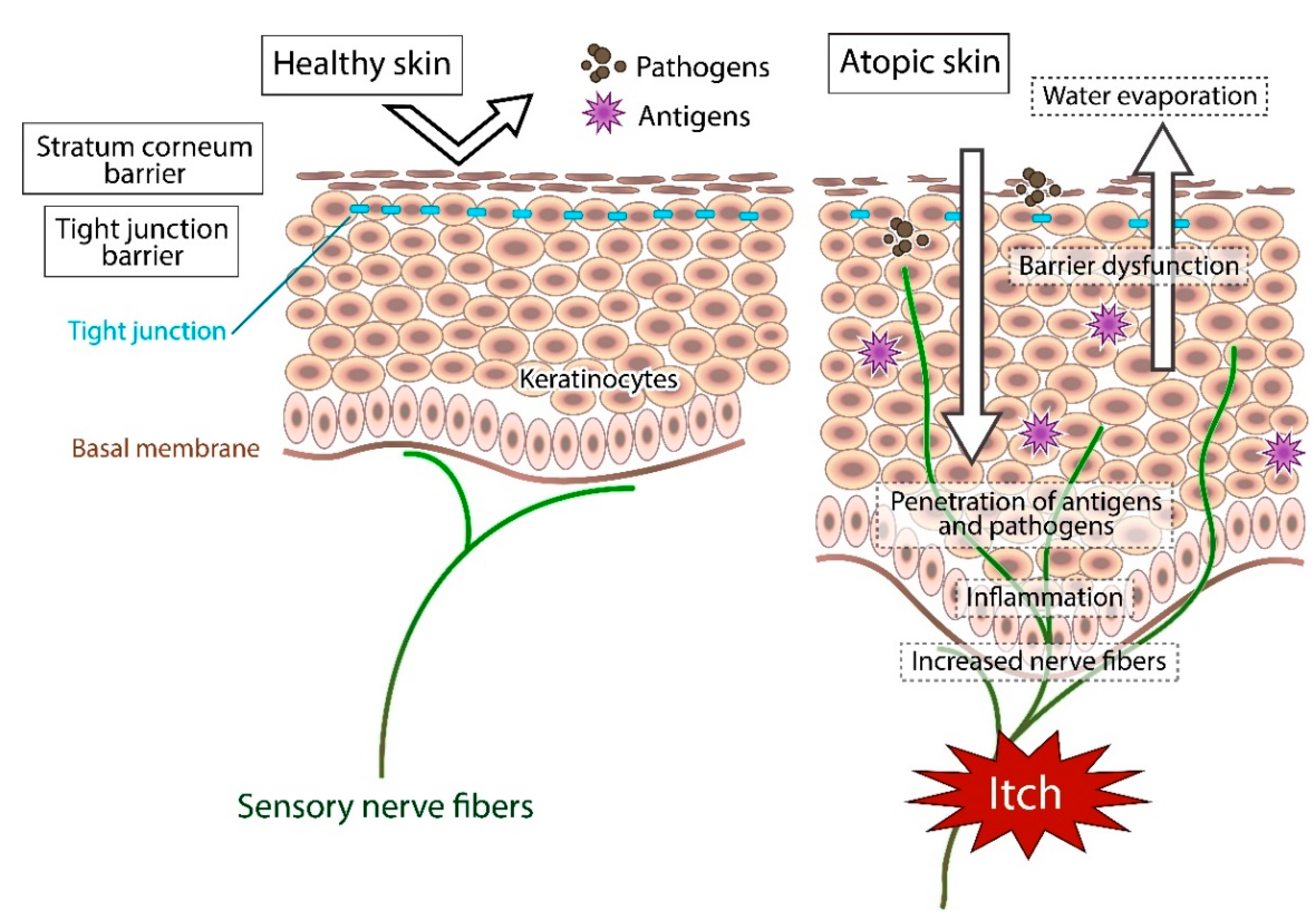 Biomedicines | Free Full-Text | Intractable Itch in Atopic Dermatitis:  Causes and Treatments