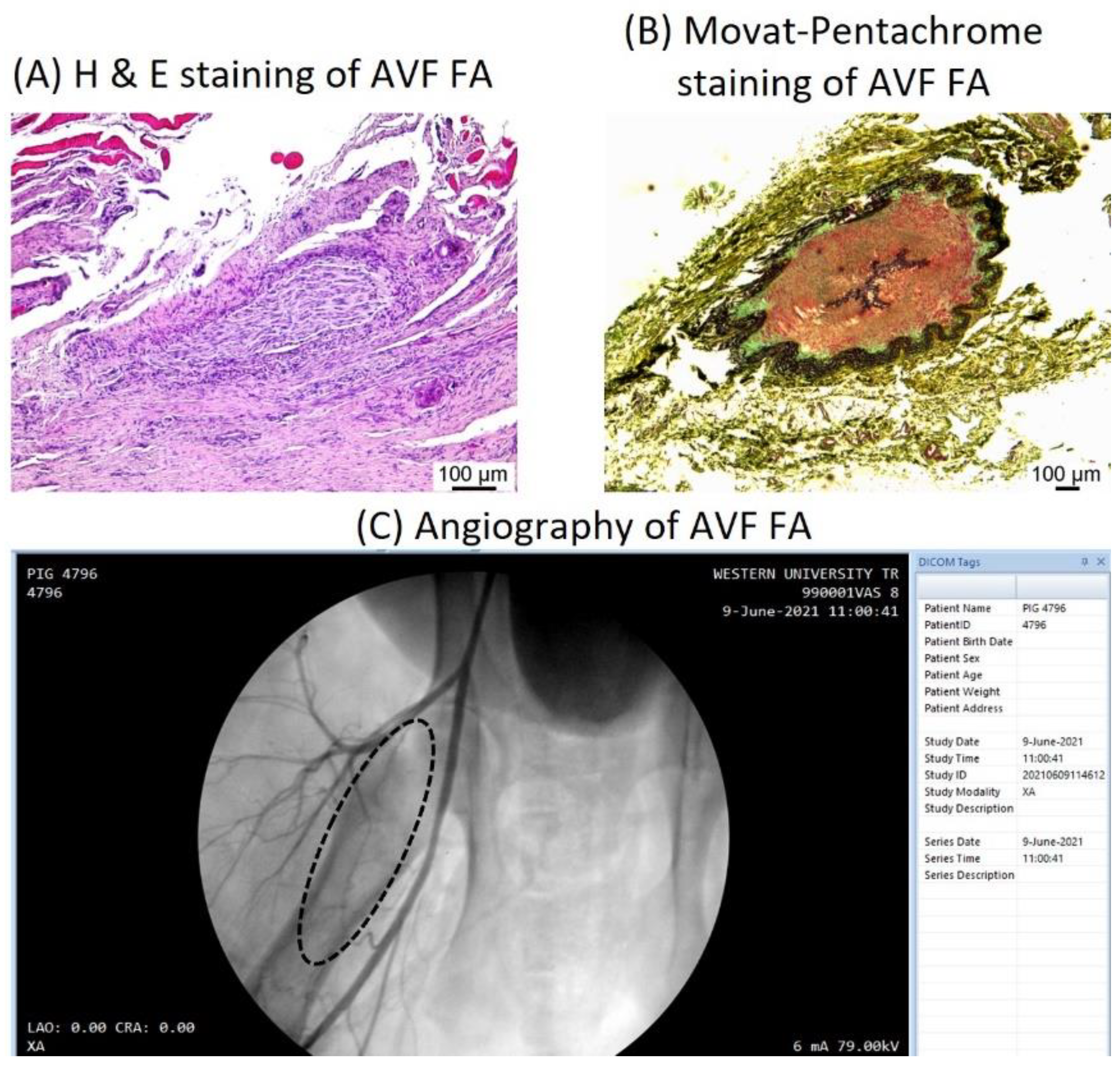 Doppler vascular mapping in Arterio Venous Fistula (AVF)