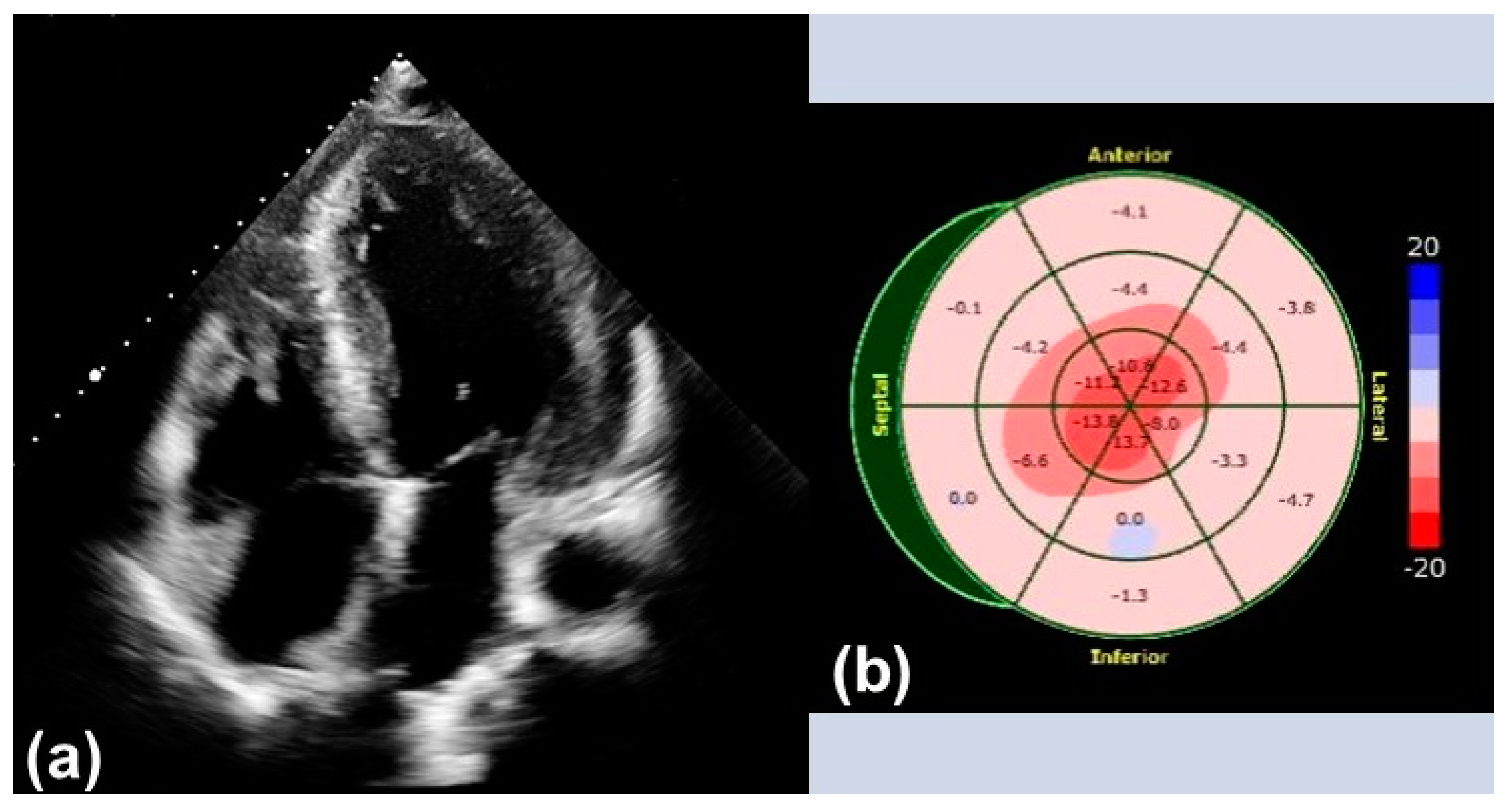 Patterns of CMR measured longitudinal strain and its association with late  gadolinium enhancement in patients with cardiac amyloidosis and its mimics, Journal of Cardiovascular Magnetic Resonance