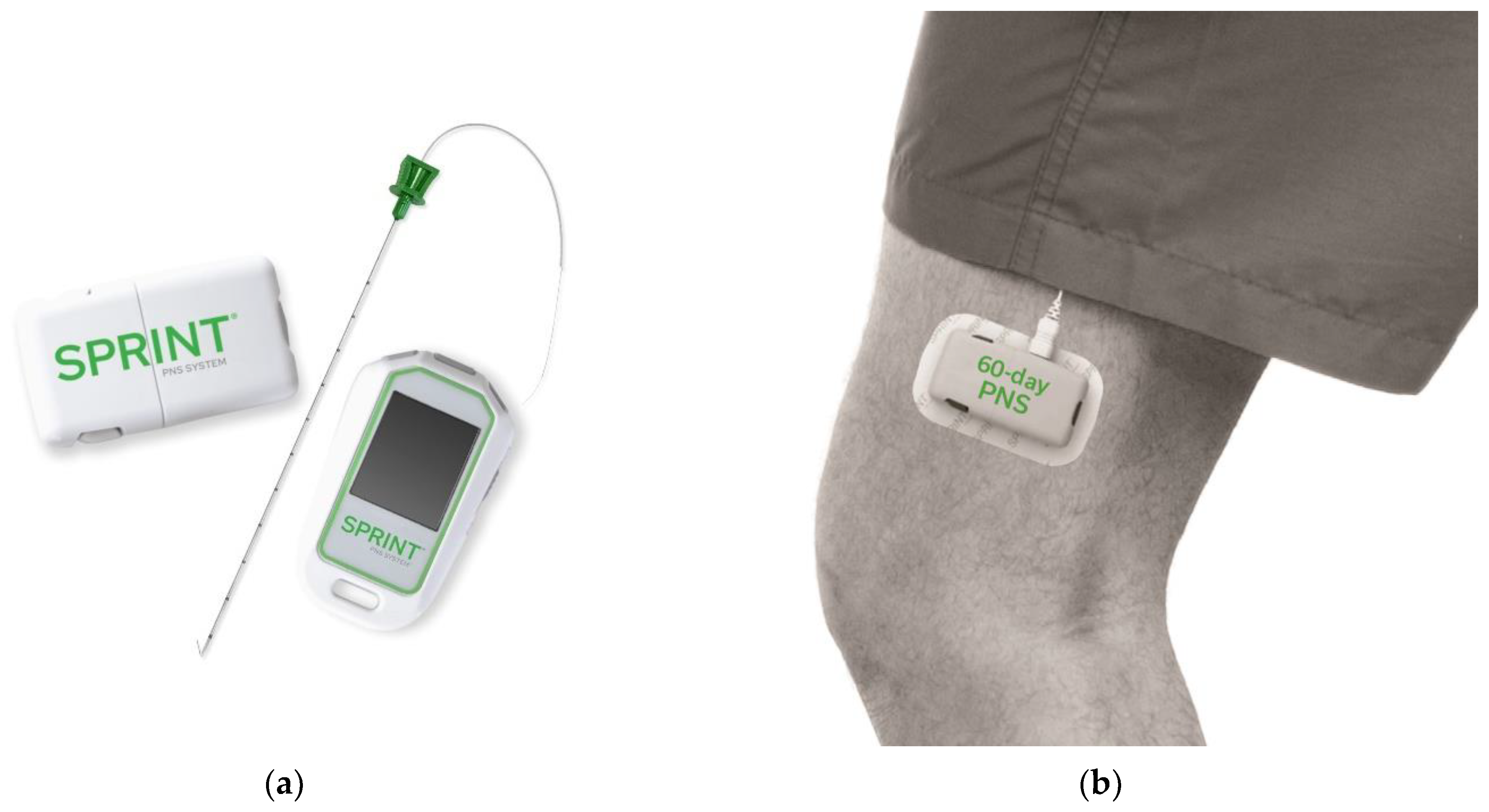 Peripheral Nerve Field Stimulation - Plainsboro Township, NJ: Regenerative  Spine and Pain Institute