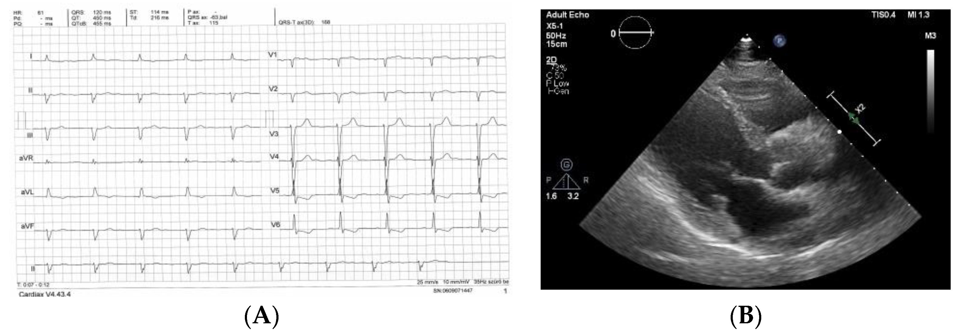 Two-dimensional Echocardiographic Assessment of Myocardial Strain:  Important Echocardiographic Parameter Readily Useful in Clinical Field. -  Abstract - Europe PMC