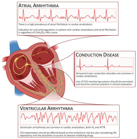 Global and Regional Variations in Transthyretin Cardiac