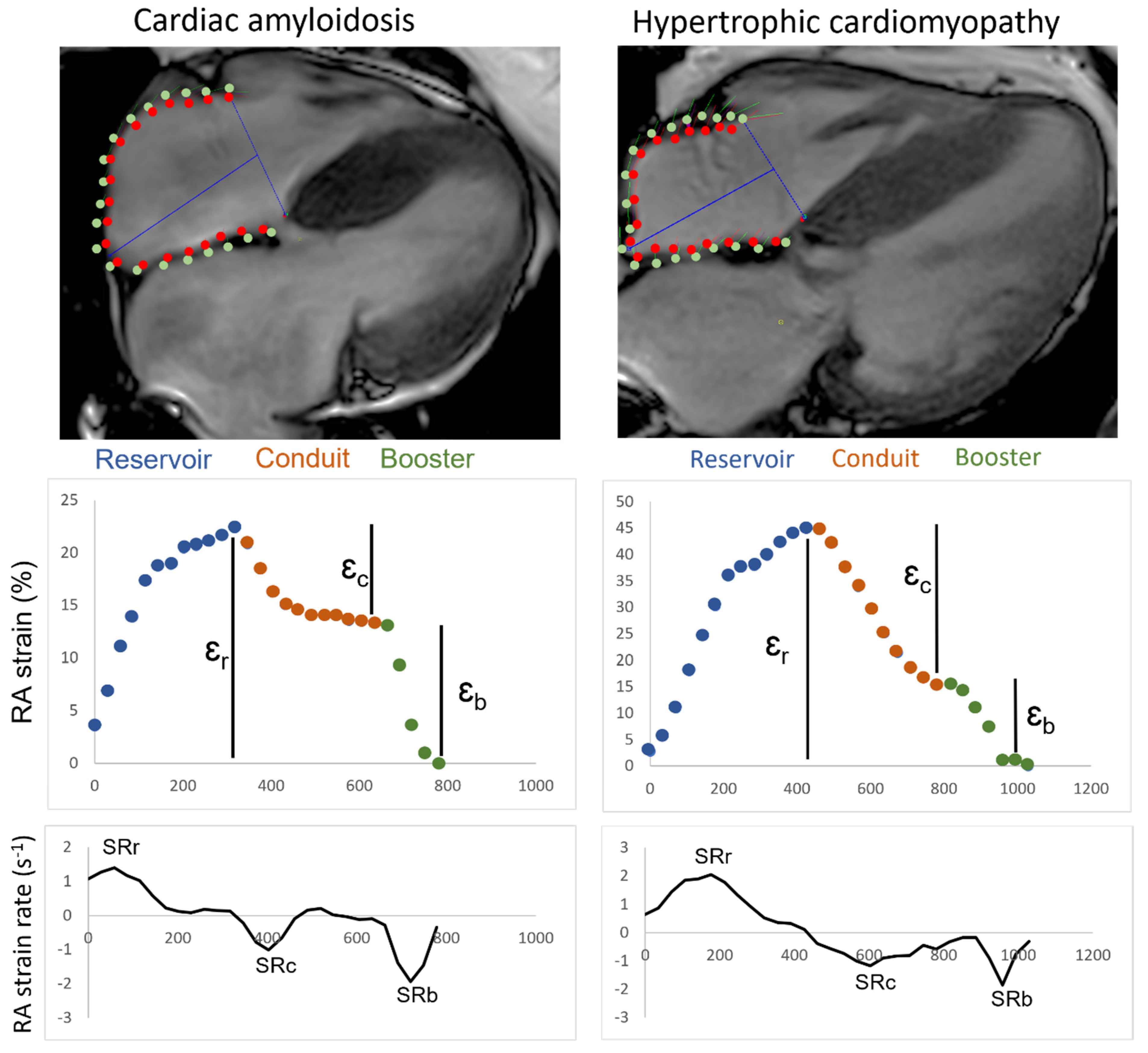 Erratum 'Prognostic implication of relative regional strain ratio in  cardiac amyloidosis