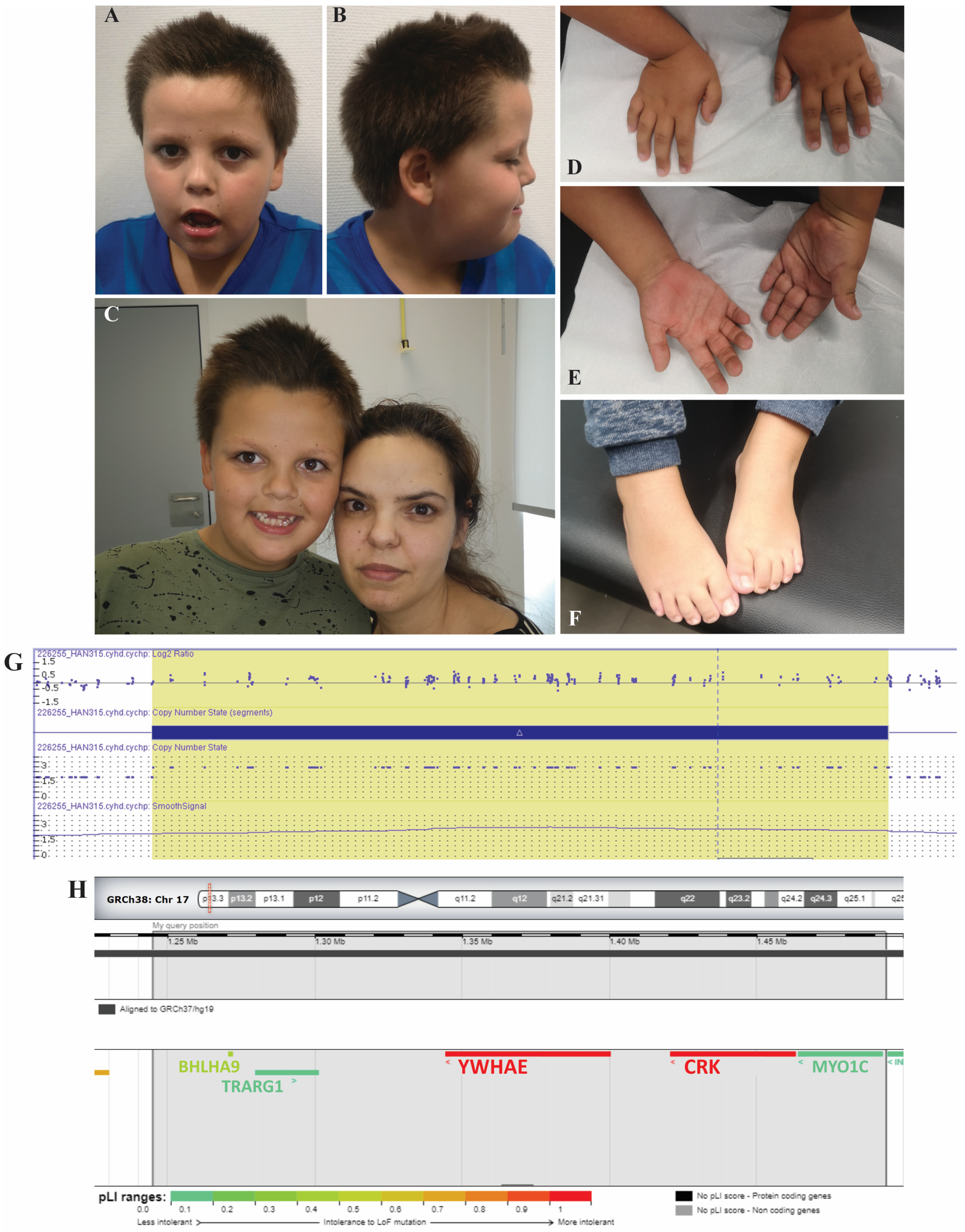 dysmorphic features symptom checker