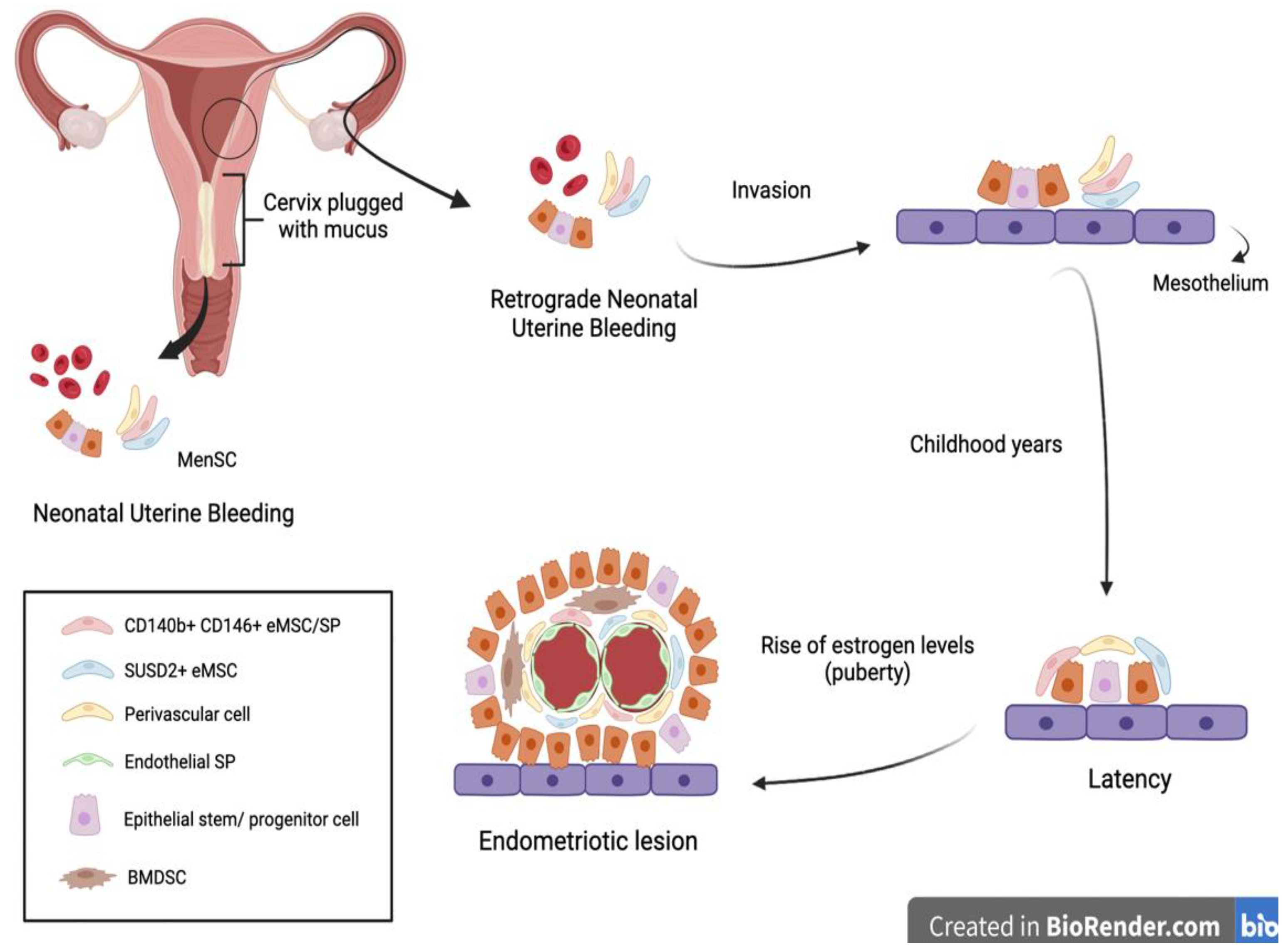 Menstrual bleeding from an endometriotic lesion - ScienceDirect