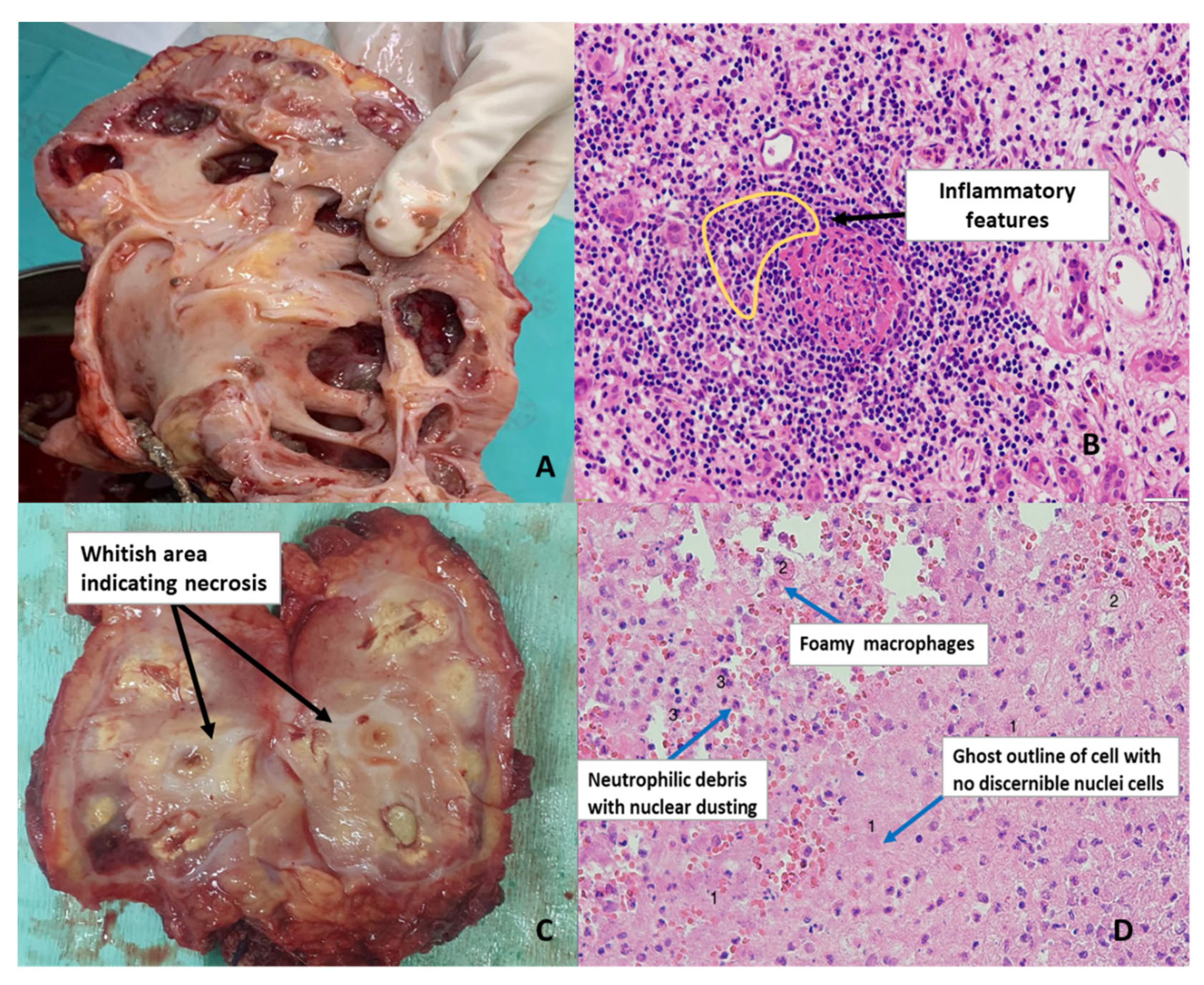 coagulative necrosis kidney