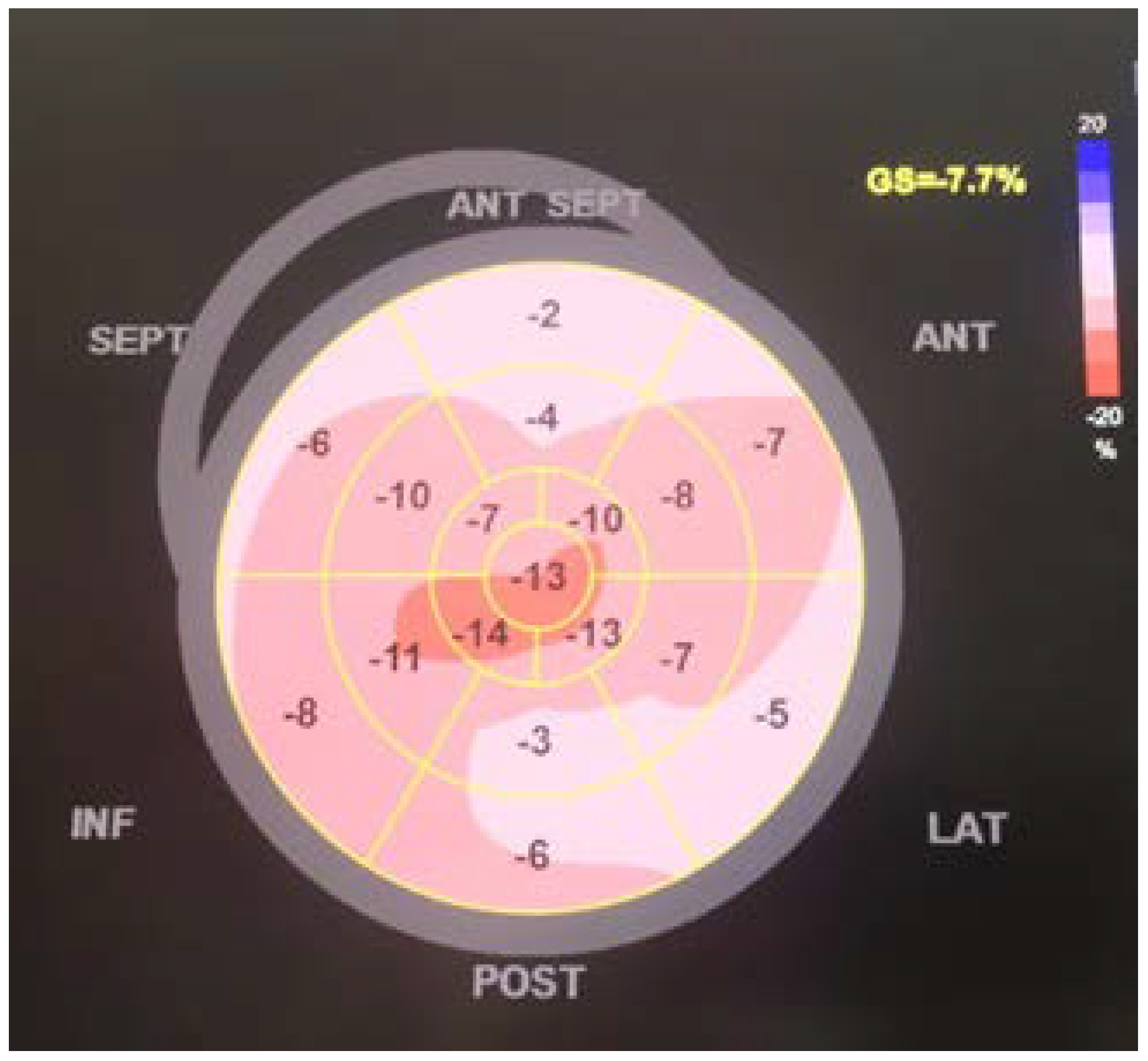 Cureus, Left Ventricular Global Longitudinal Strain in Patients With  COVID-19 Infection