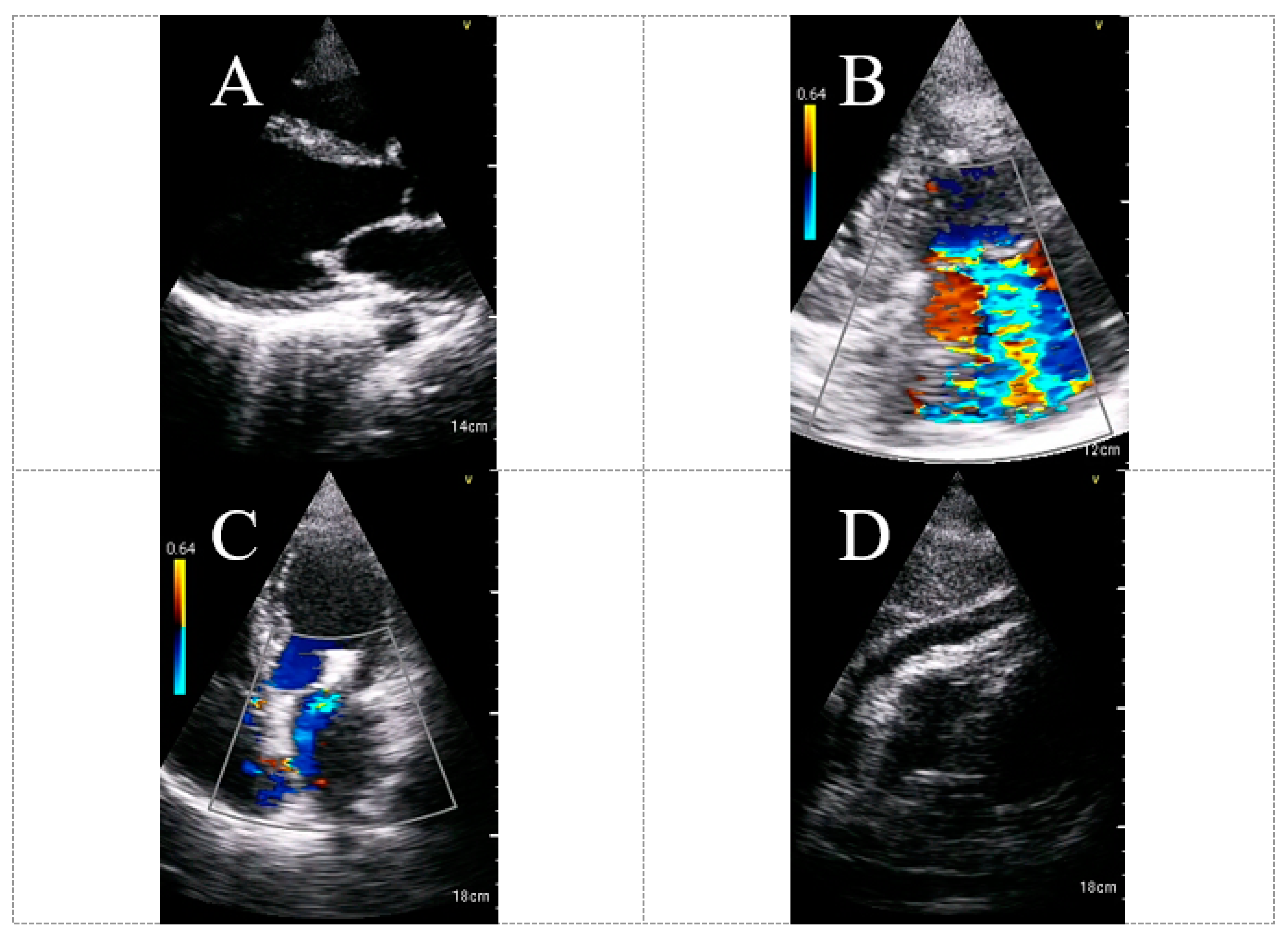 Could strain echocardiography help to assess systolic function in  critically ill COVID-19 patients?