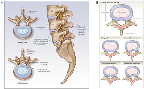 Nonsurgical treatment options for lumbar spinal stenosis - Mayo Clinic