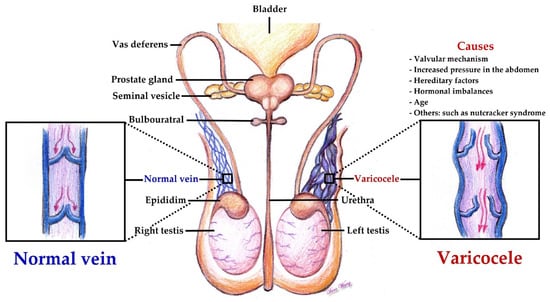 Biomedicines | Free Full-Text | Scrotal Pain after Varicocelectomy: A  Narrative Review