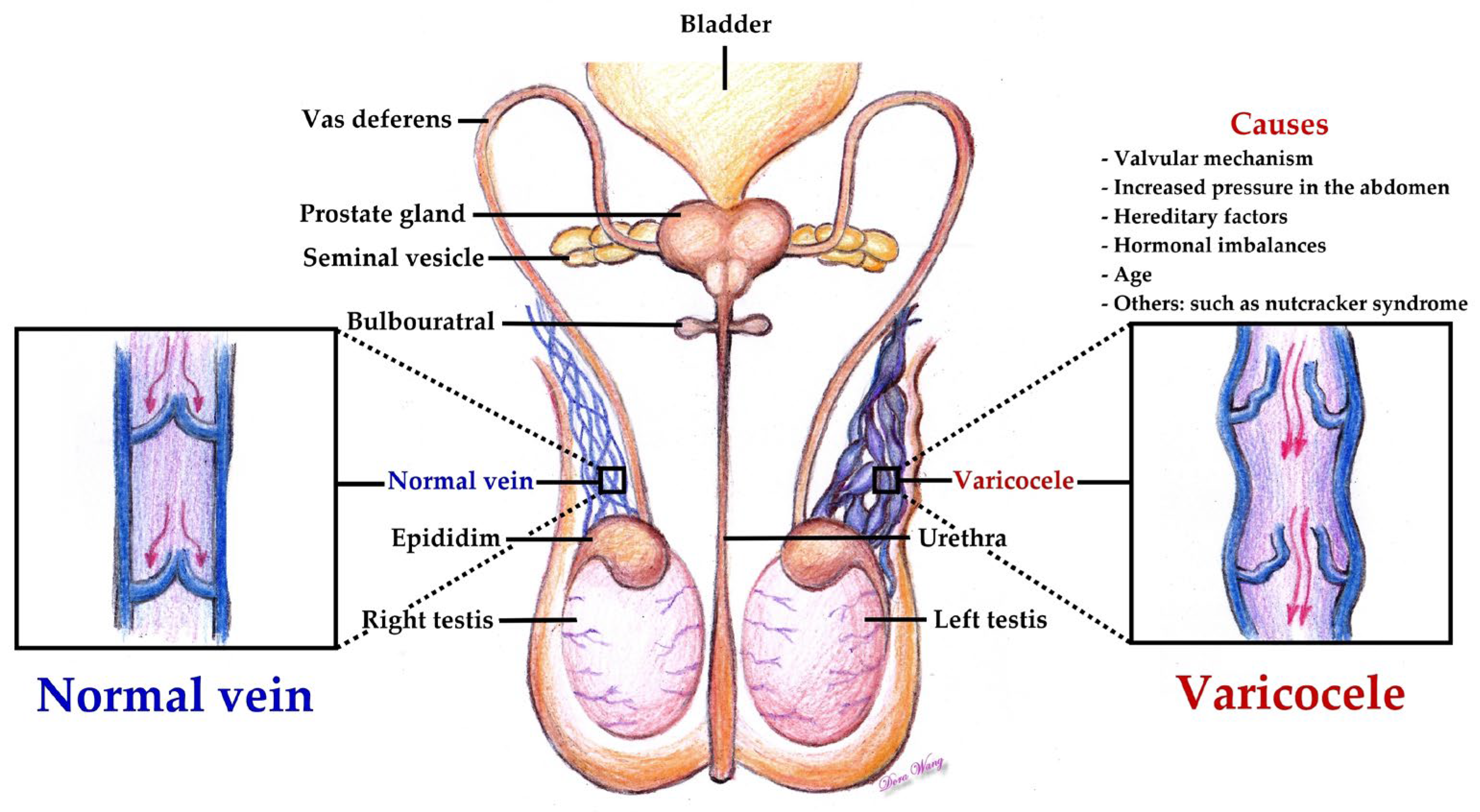 CRETO Scrotal Support, for varicocele and hydrocele lift to the