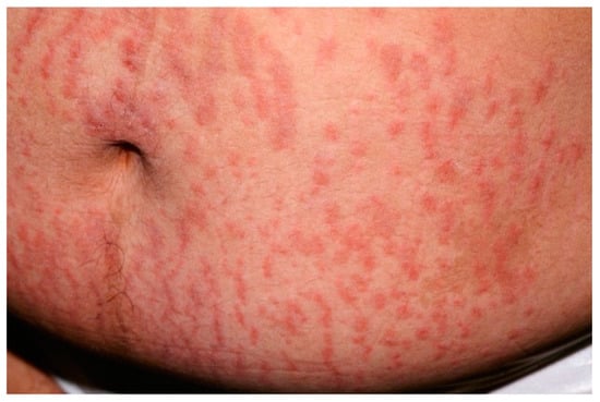 A and B , Hypereosinophilic syndrome. Polymorphic rash with