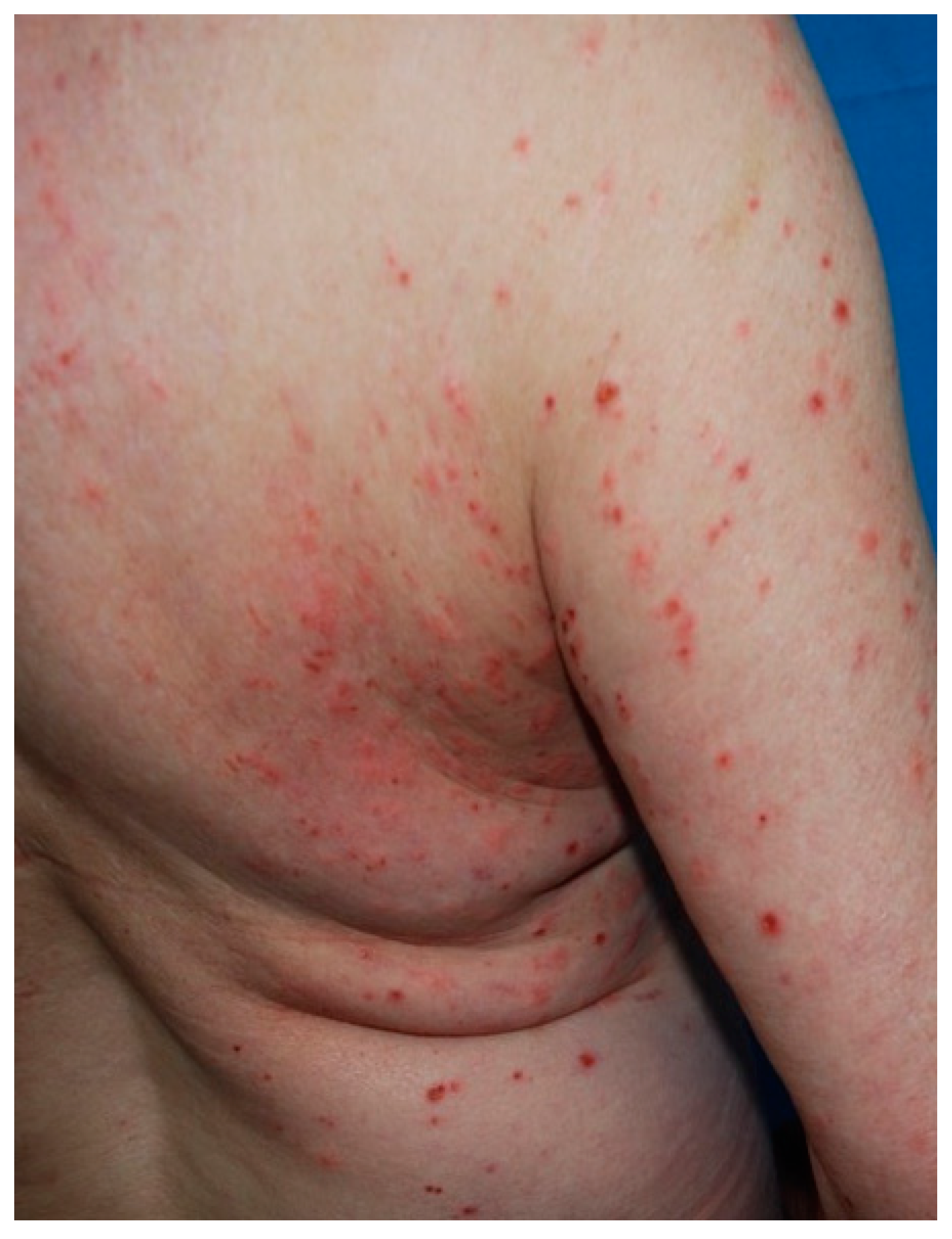 Hives (urticaria) on the back and buttocks: MedlinePlus Medical  Encyclopedia Image